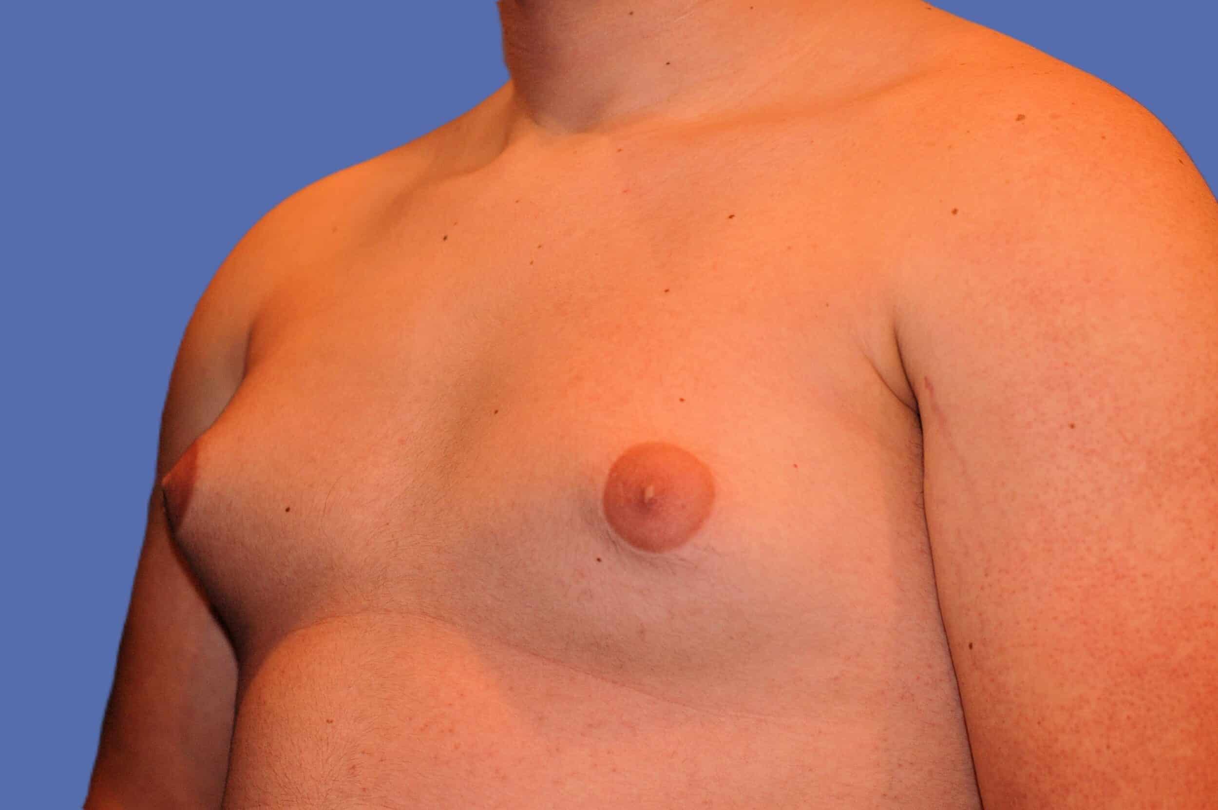 Before Image: Male Breast Reduction (Gynecomastia) - left-front-oblique