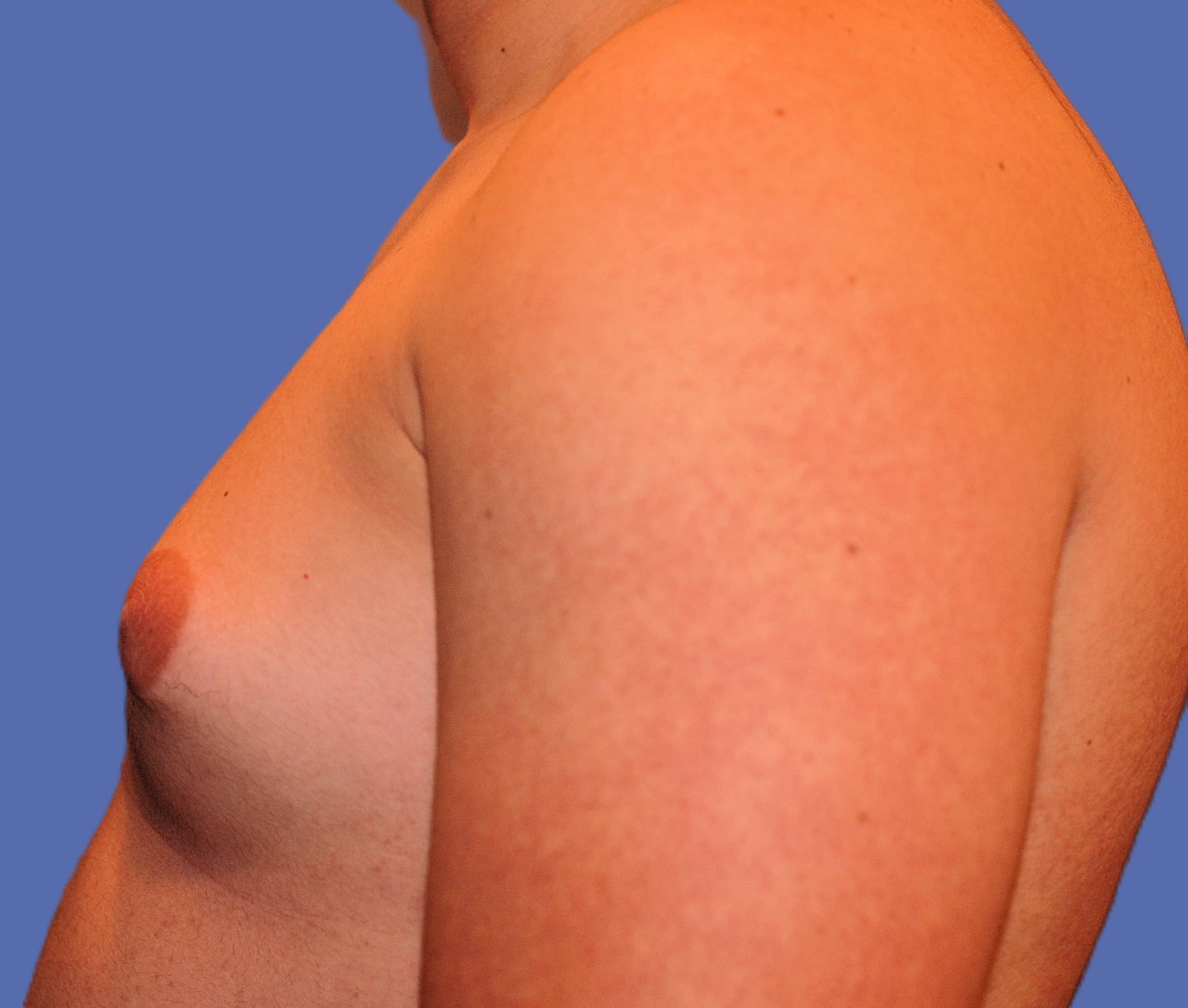 Before Image: Male Breast Reduction (Gynecomastia) - left-side