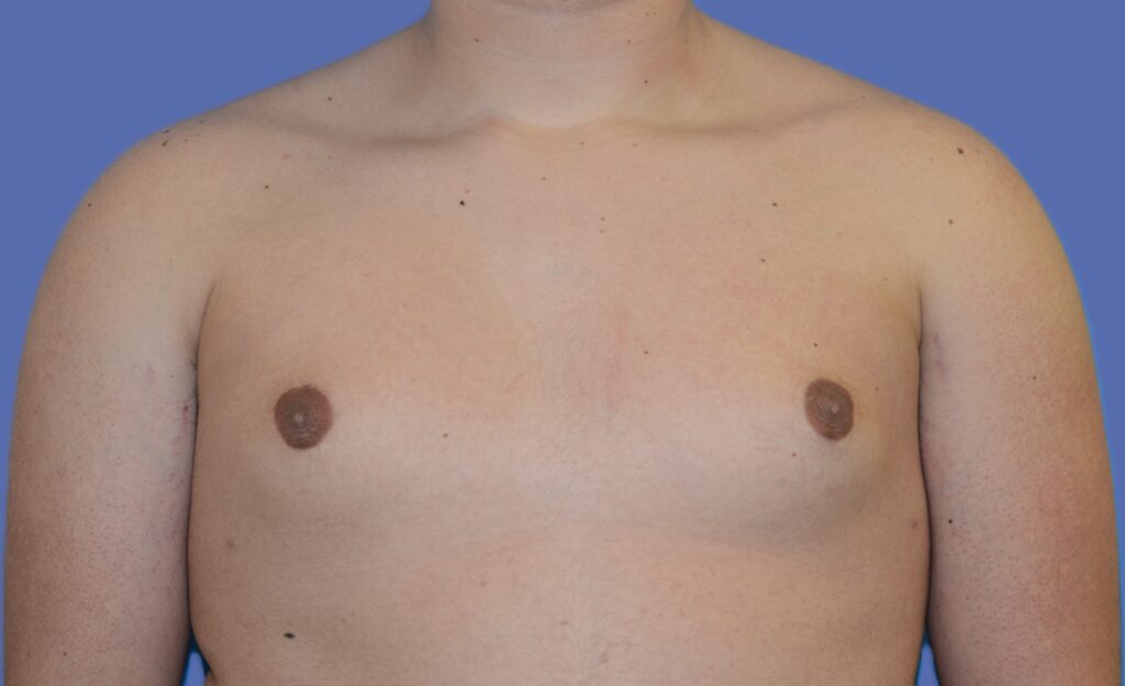 After Image: Male Breast Reduction (Gynecomastia) - front