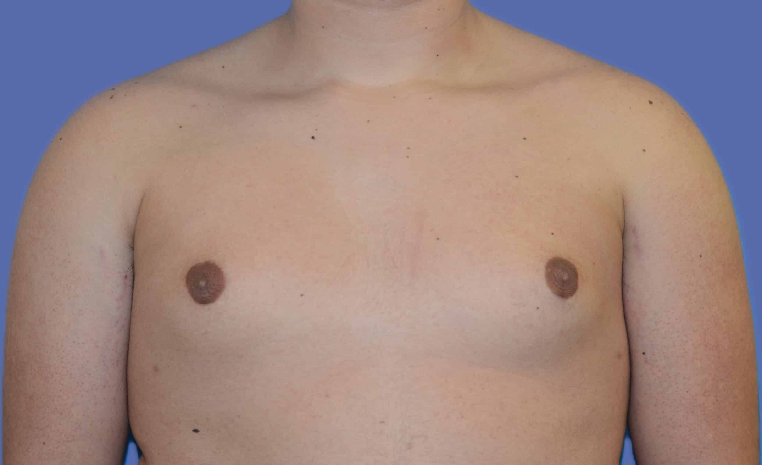 After Image: Male Breast Reduction (Gynecomastia) - front
