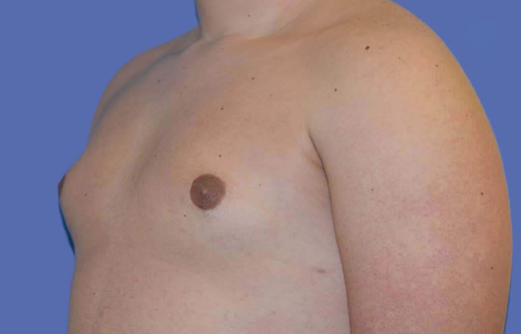 After Image: Male Breast Reduction (Gynecomastia) - left-front-oblique