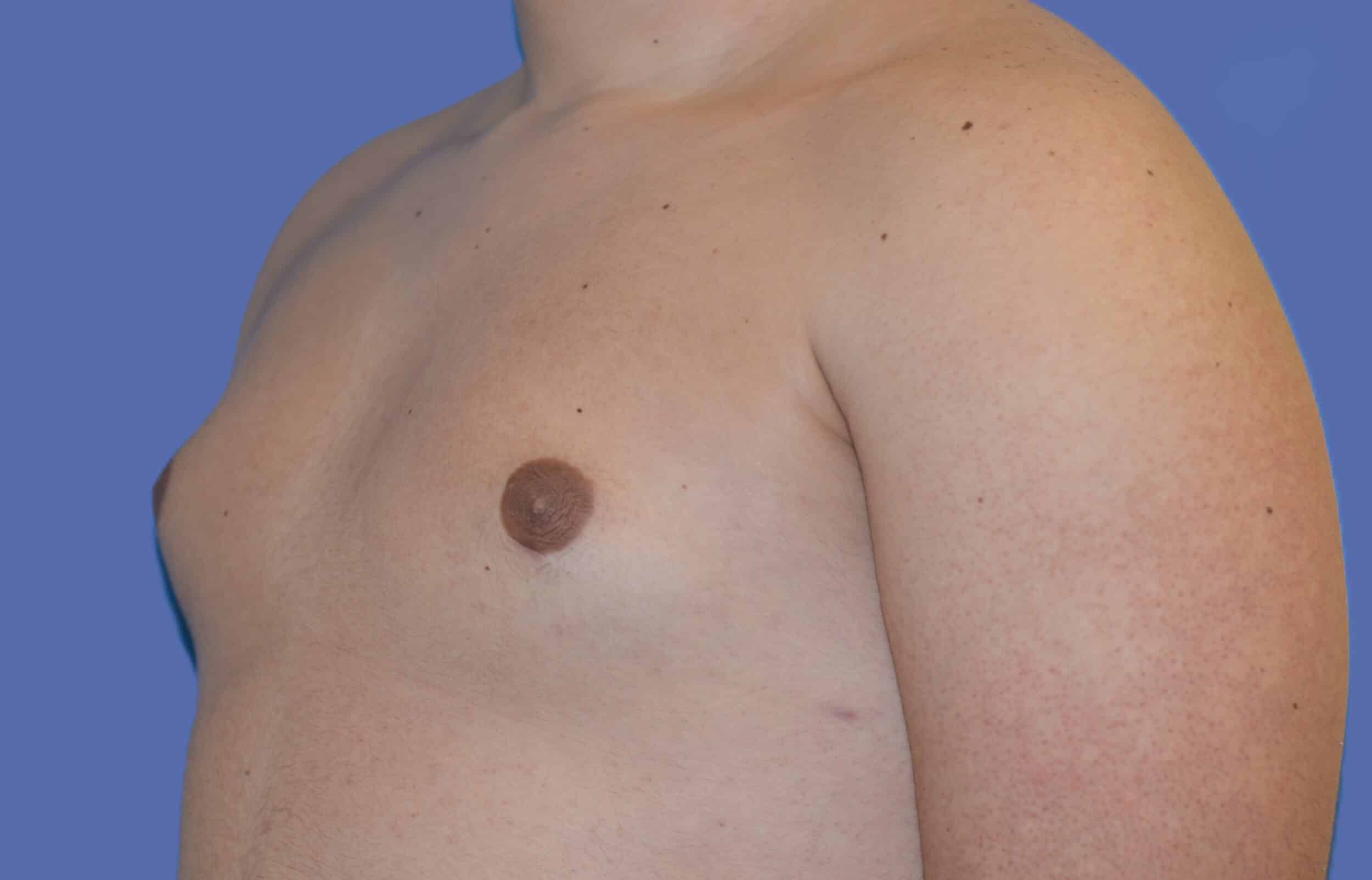After Image: Male Breast Reduction (Gynecomastia) - left-front-oblique