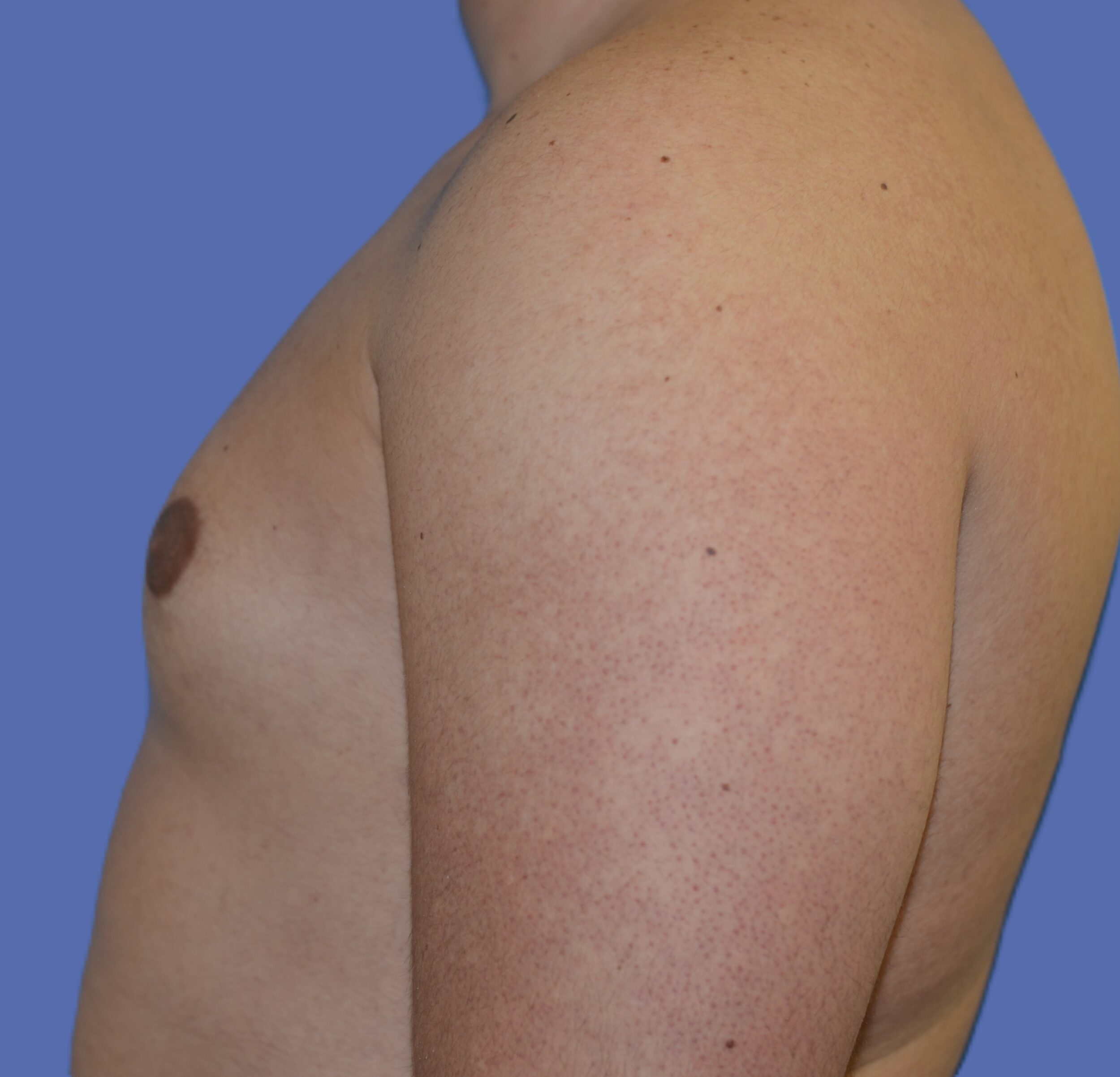 After Image: Male Breast Reduction (Gynecomastia) - left-side