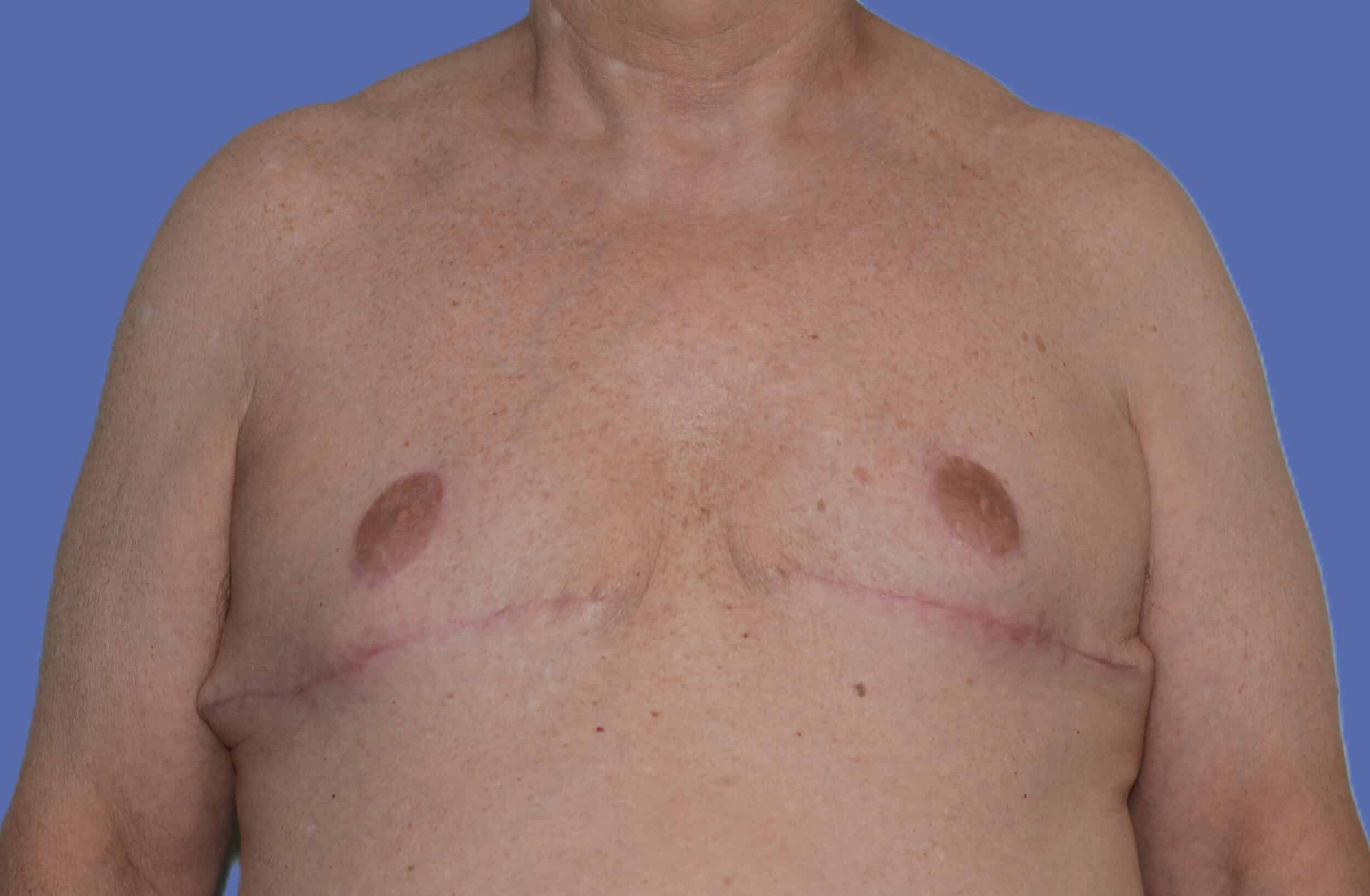 After Image: Male Breast Reduction (Gynecomastia) - front
