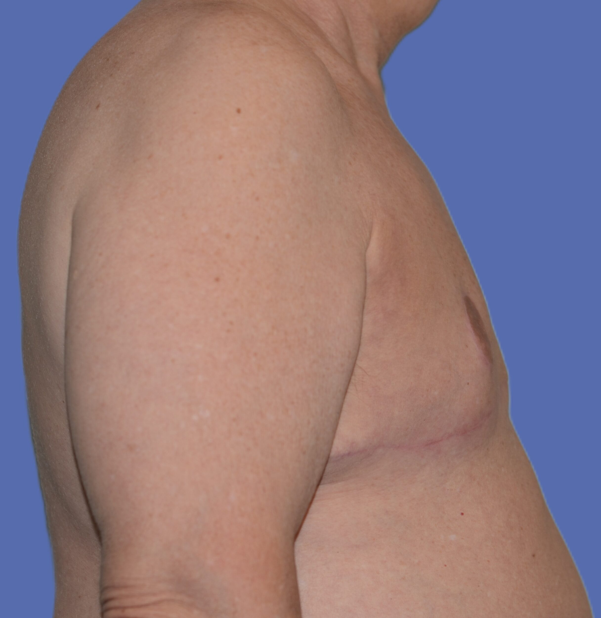 After Image: Male Breast Reduction (Gynecomastia) - right-side
