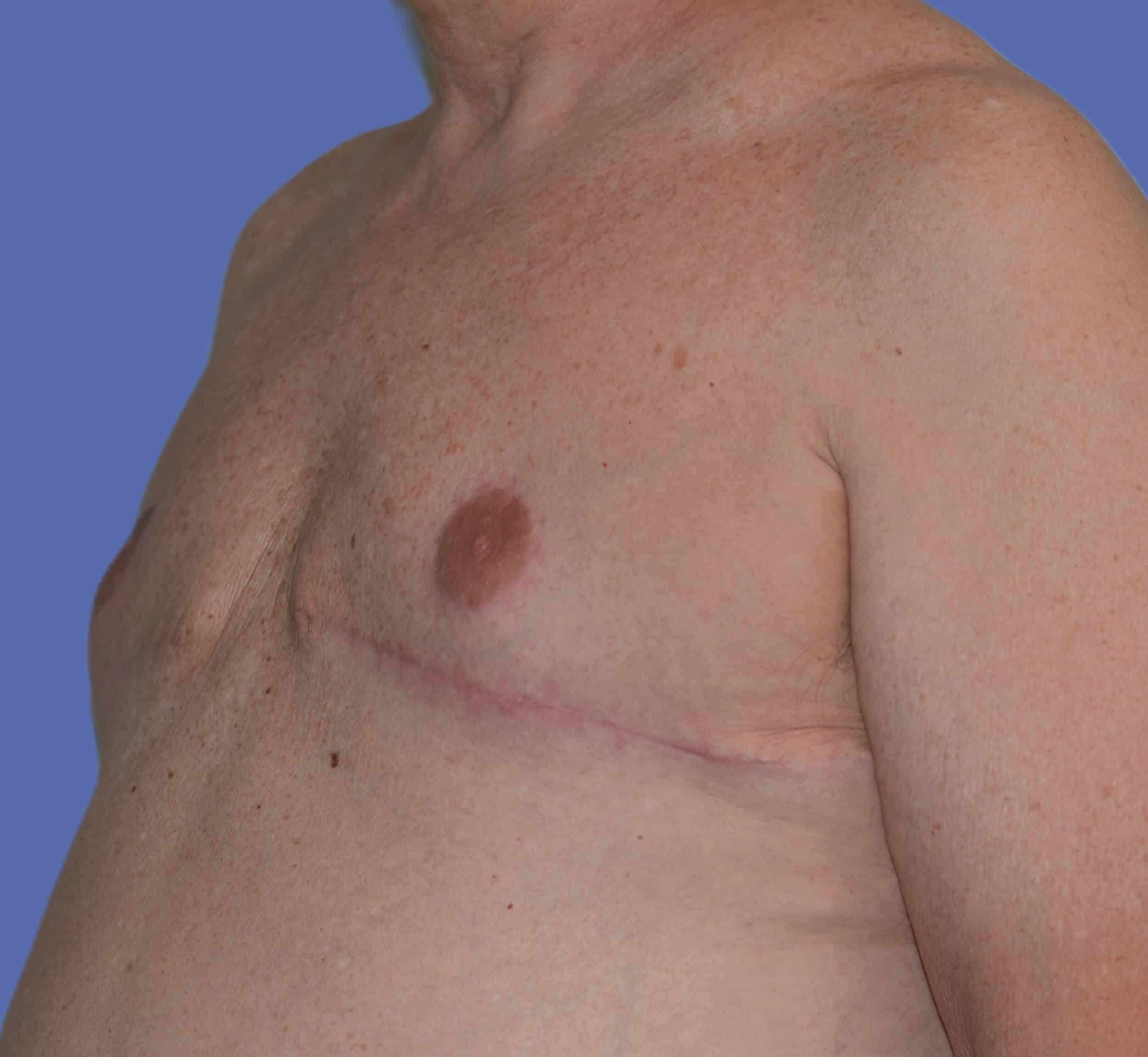 After Image: Male Breast Reduction (Gynecomastia) - left-front-oblique