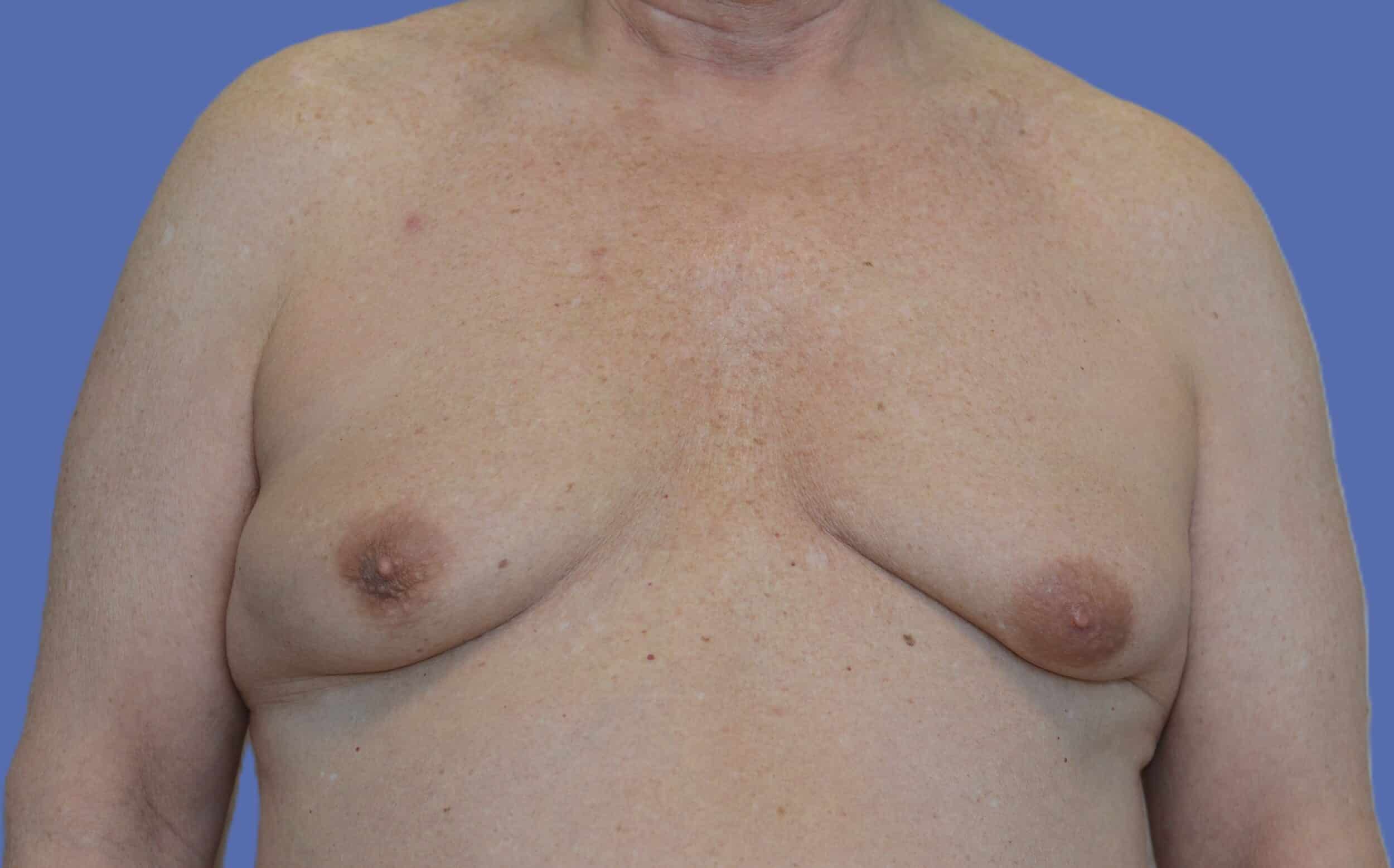 Before Image: Male Breast Reduction (Gynecomastia) - front