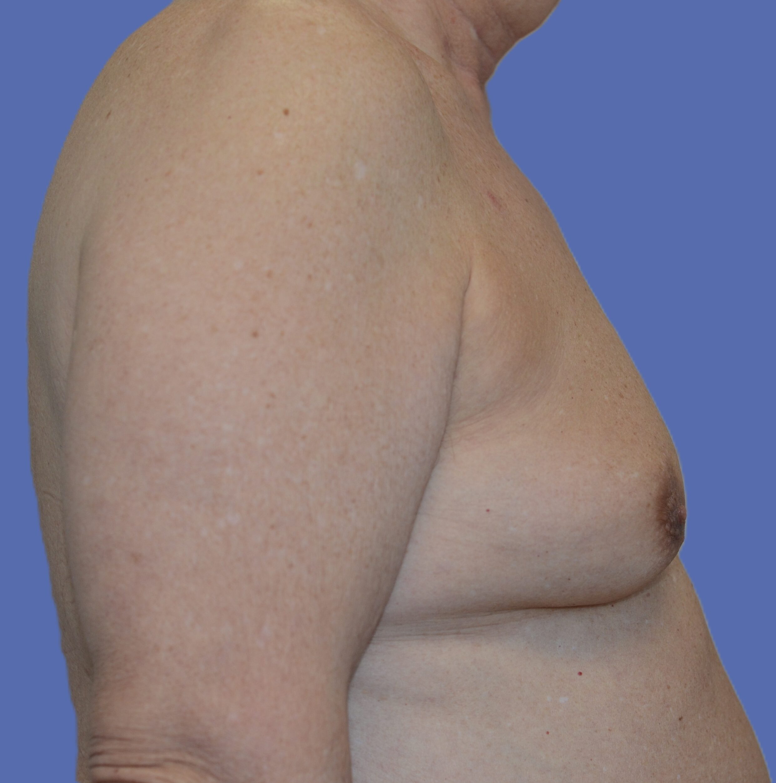 Before Image: Male Breast Reduction (Gynecomastia) - right-side