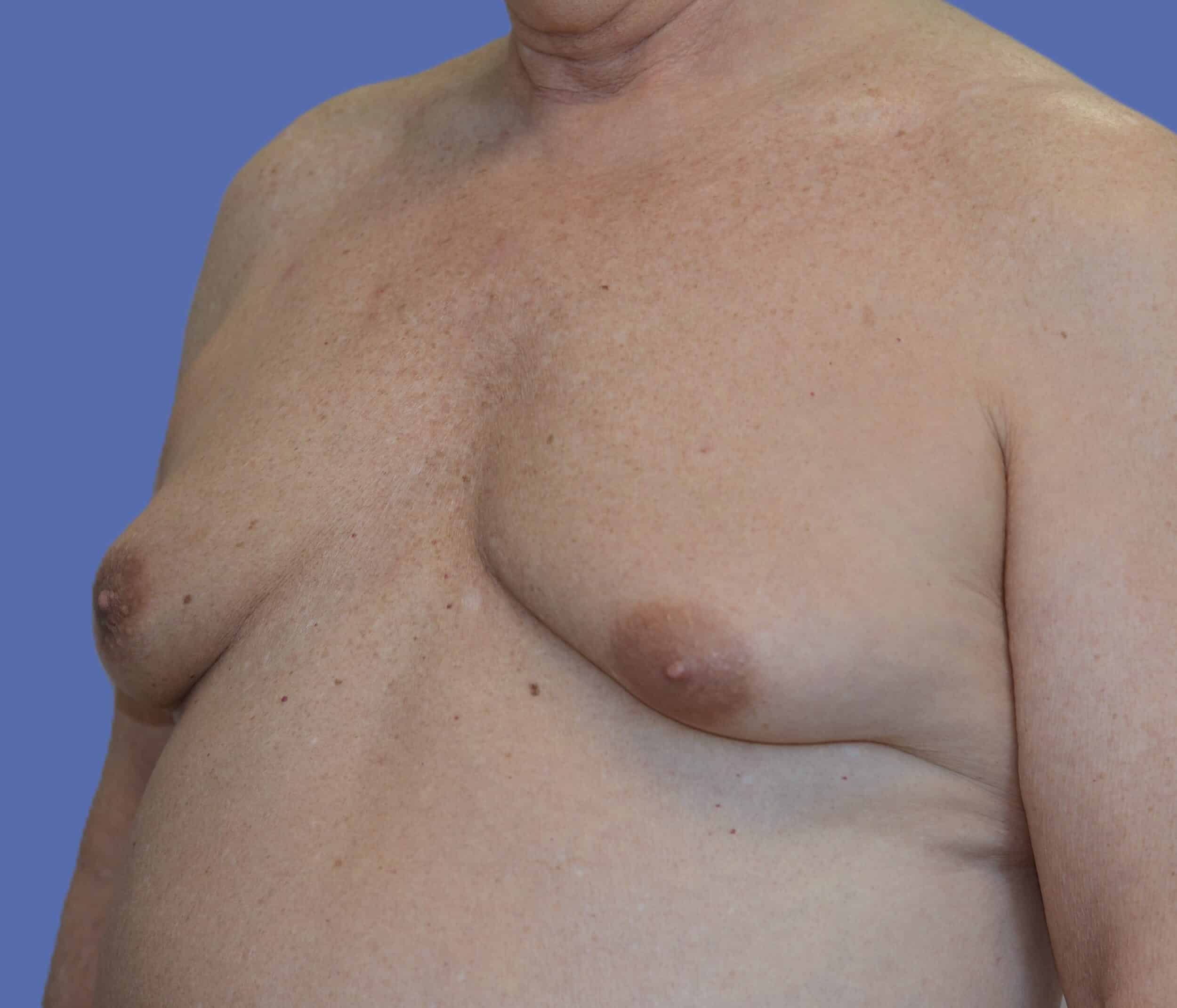 Before Image: Male Breast Reduction (Gynecomastia) - left-front-oblique