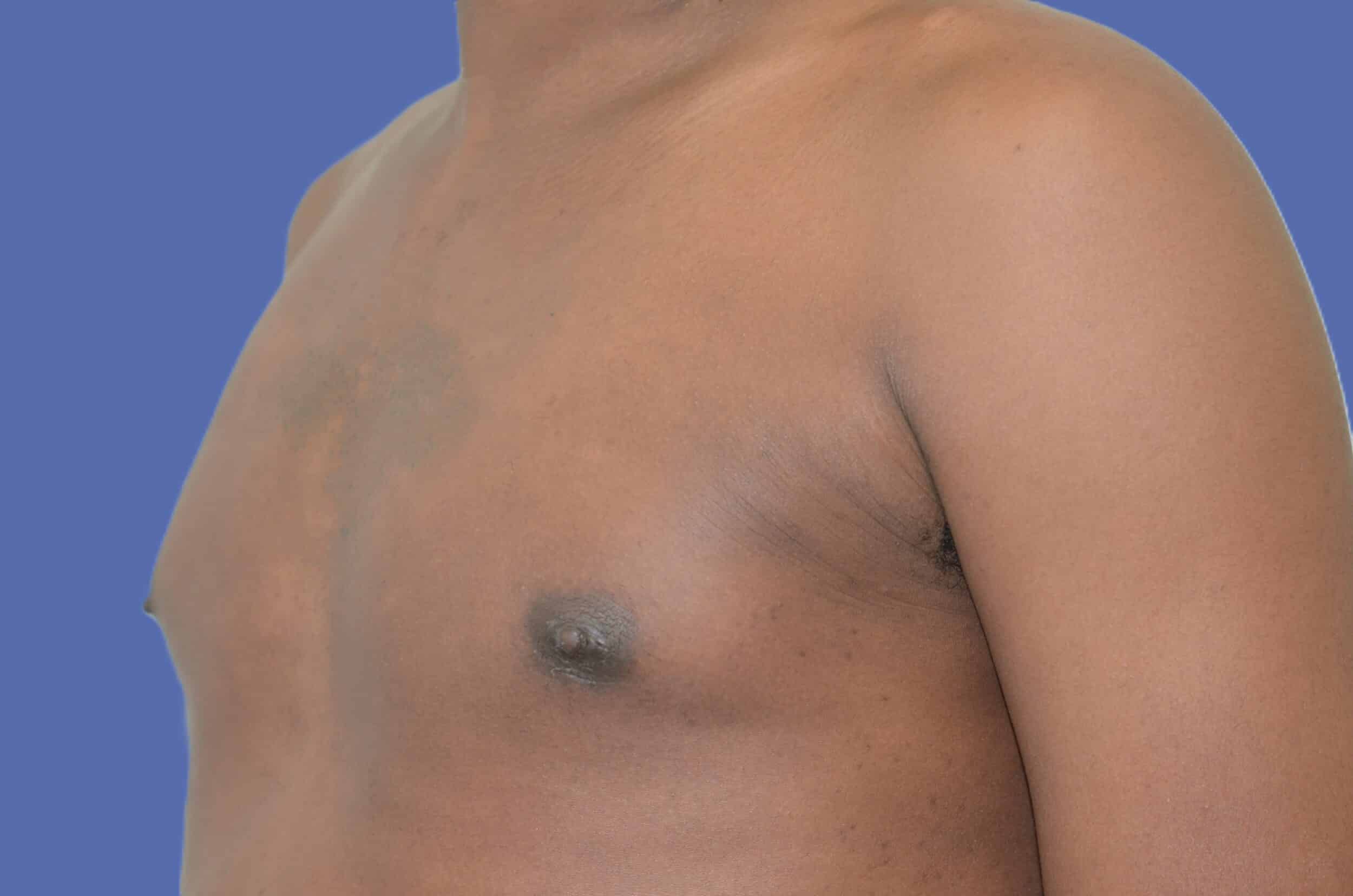 After Image: Male Breast Reduction (Gynecomastia) - left-front-oblique