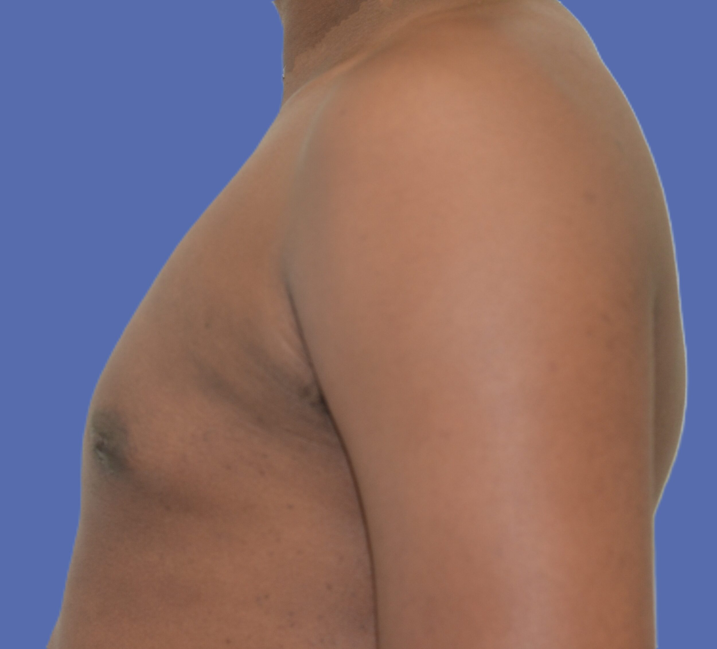 After Image: Male Breast Reduction (Gynecomastia) - left-side