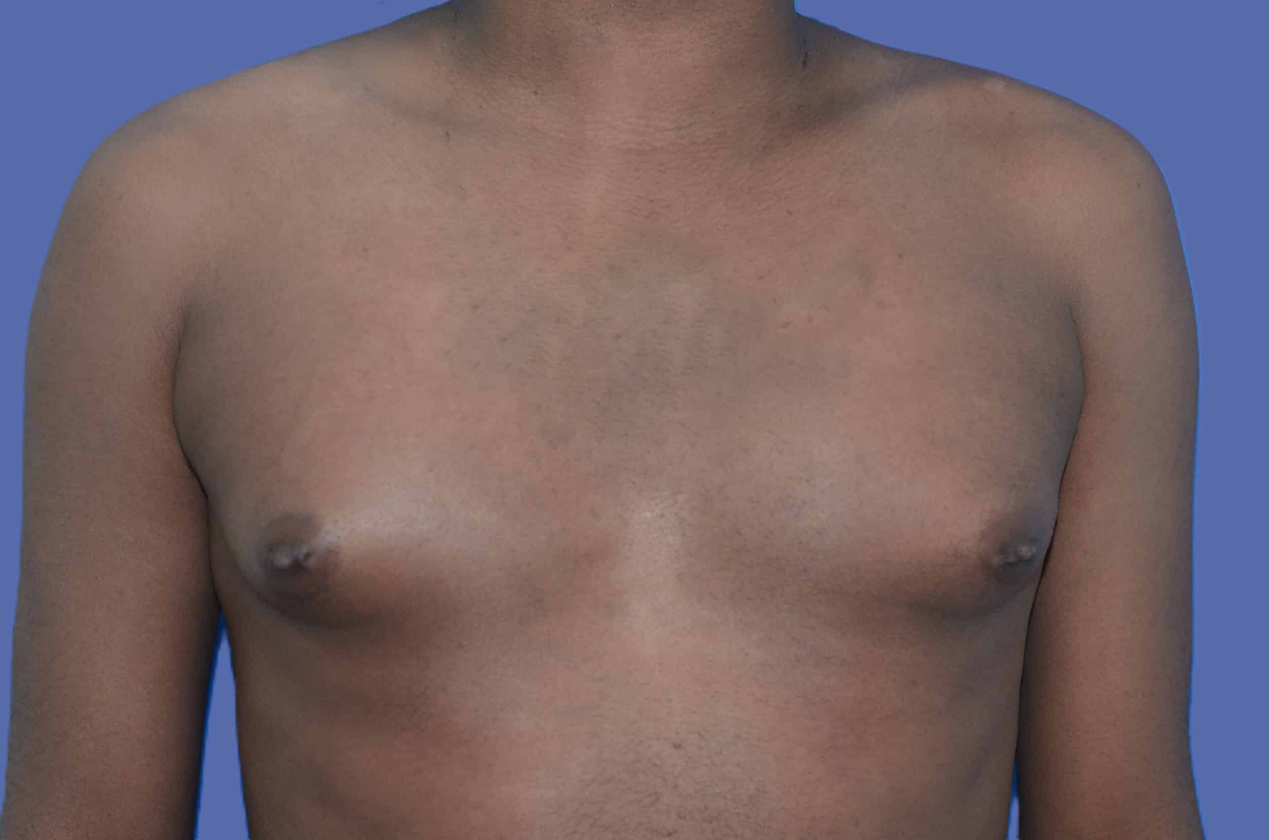 Before Image: Male Breast Reduction (Gynecomastia) - front