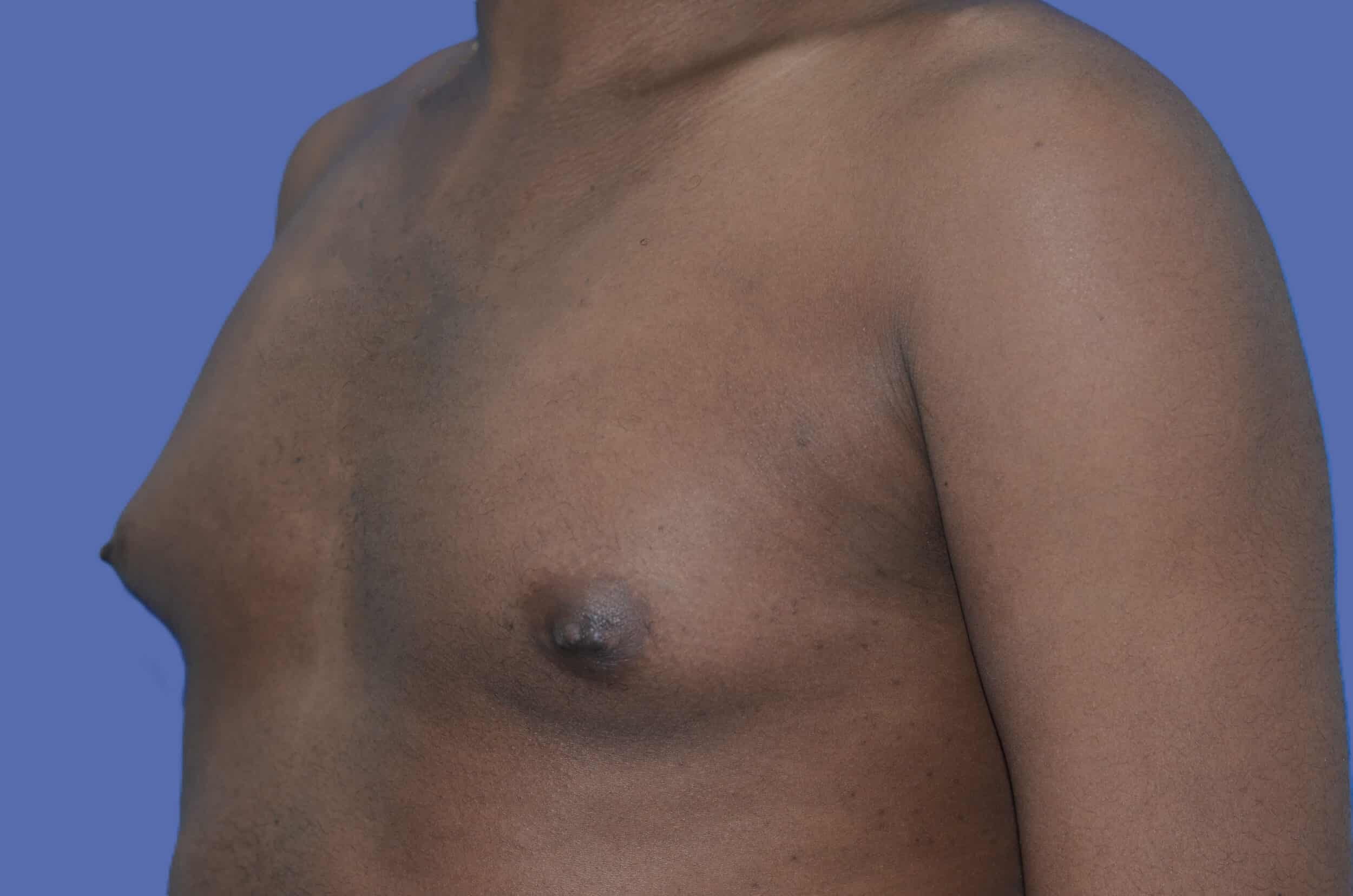 Before Image: Male Breast Reduction (Gynecomastia) - left-front-oblique
