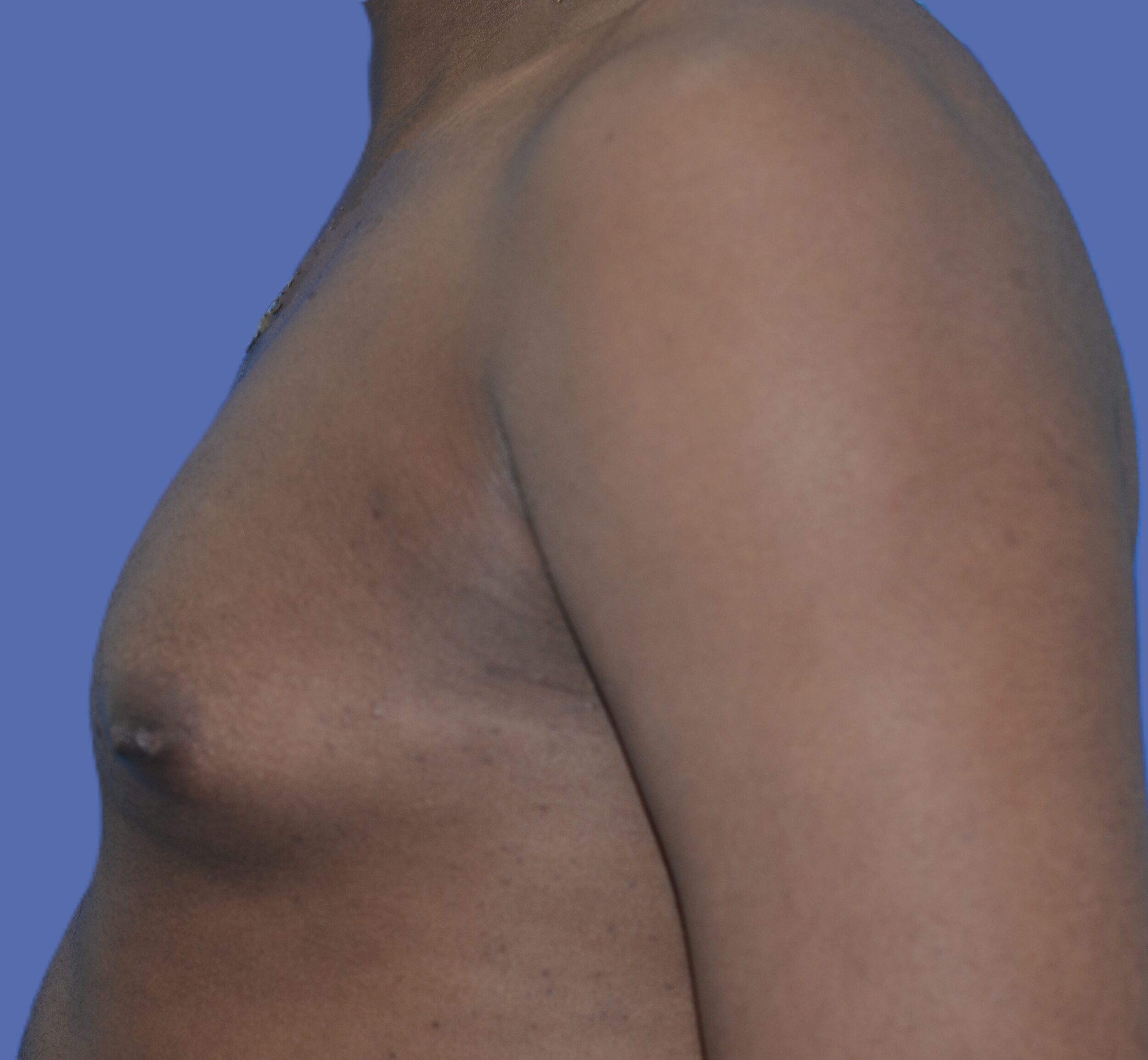 Before Image: Male Breast Reduction (Gynecomastia) - left-side