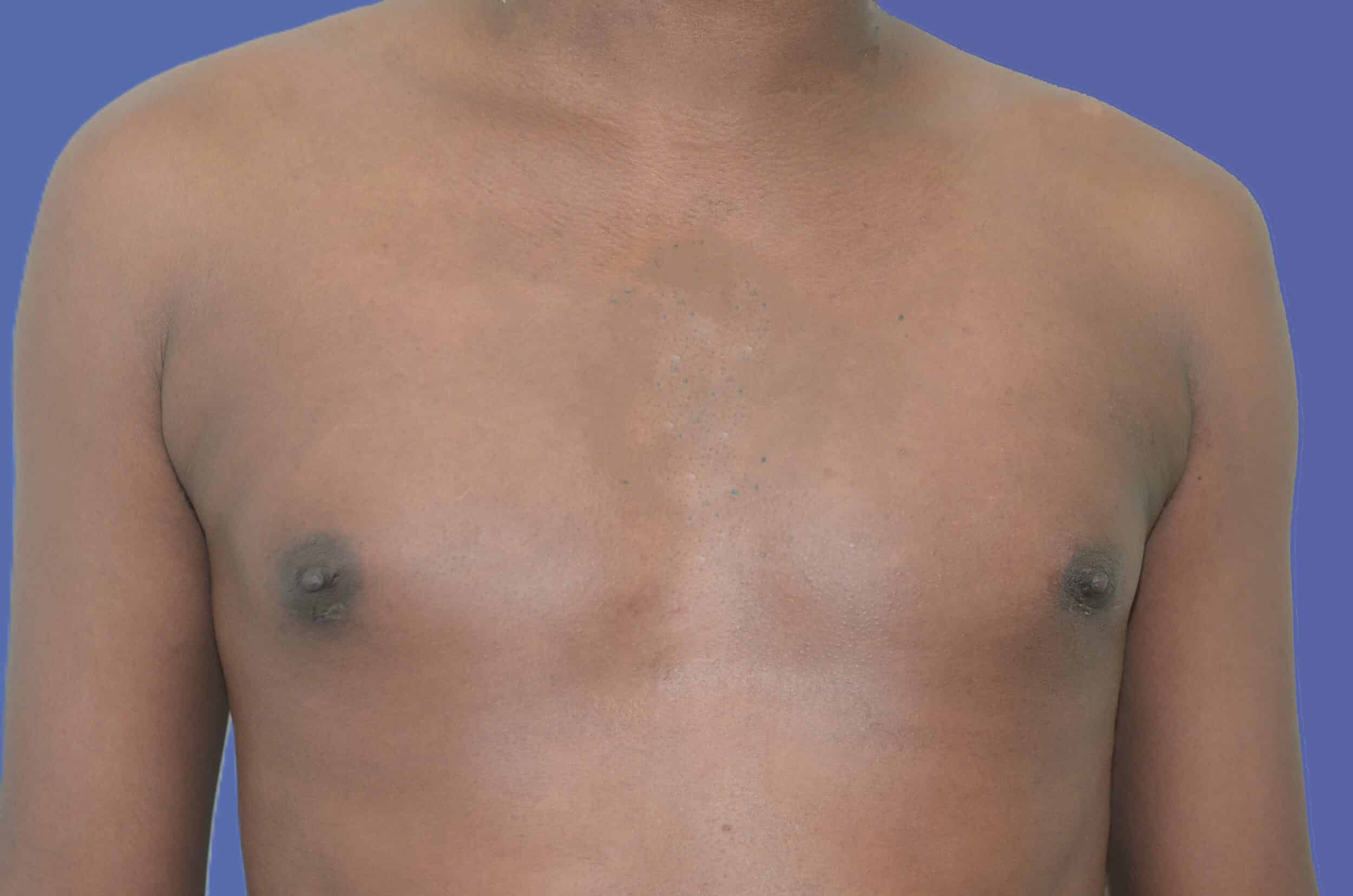 After Image: Male Breast Reduction (Gynecomastia) - front