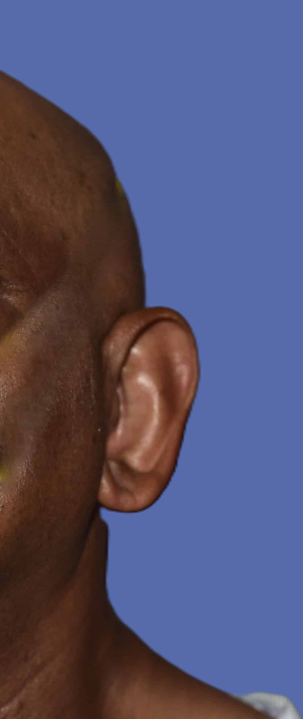 Before Image: Otoplasty (Ear Pinning) - left-front-oblique