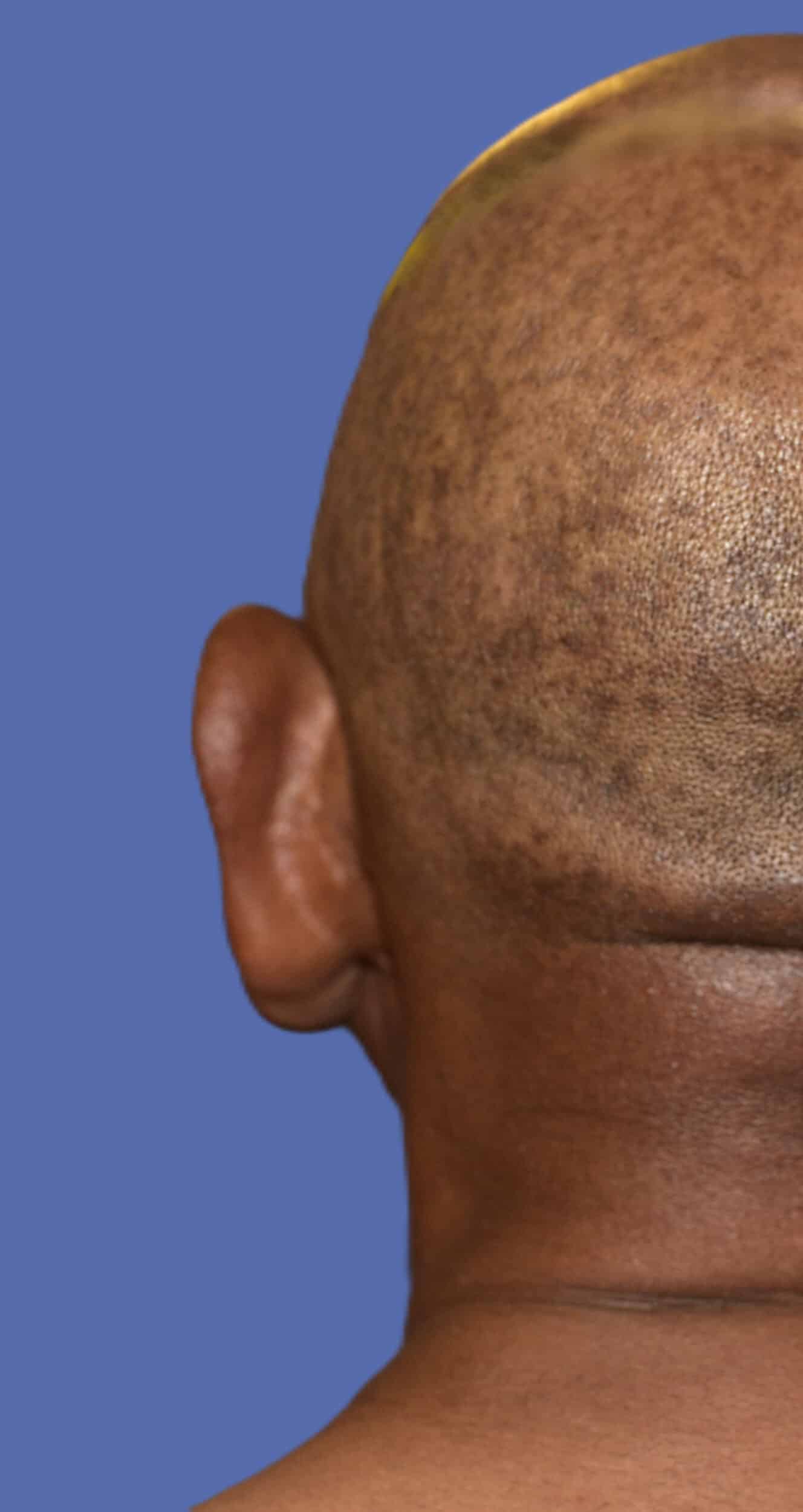 Before Image: Otoplasty (Ear Pinning) - back
