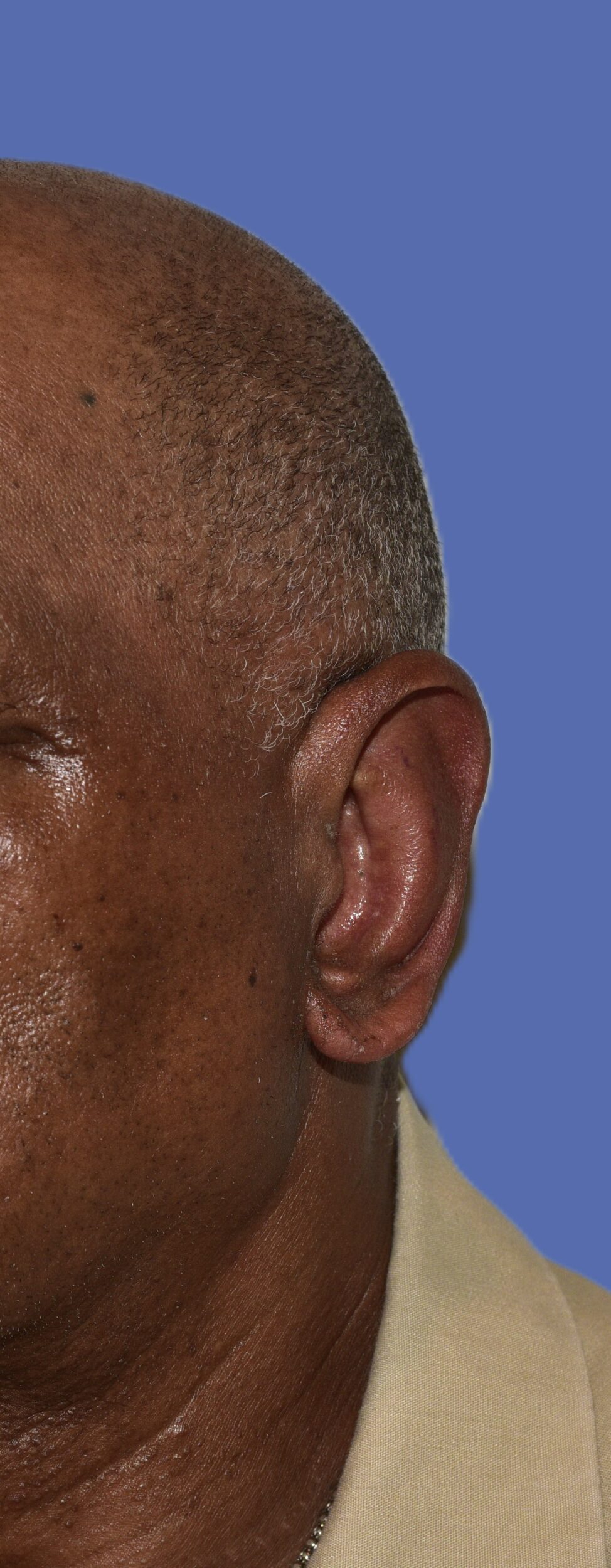 After Image: Otoplasty (Ear Pinning) - left-front-oblique