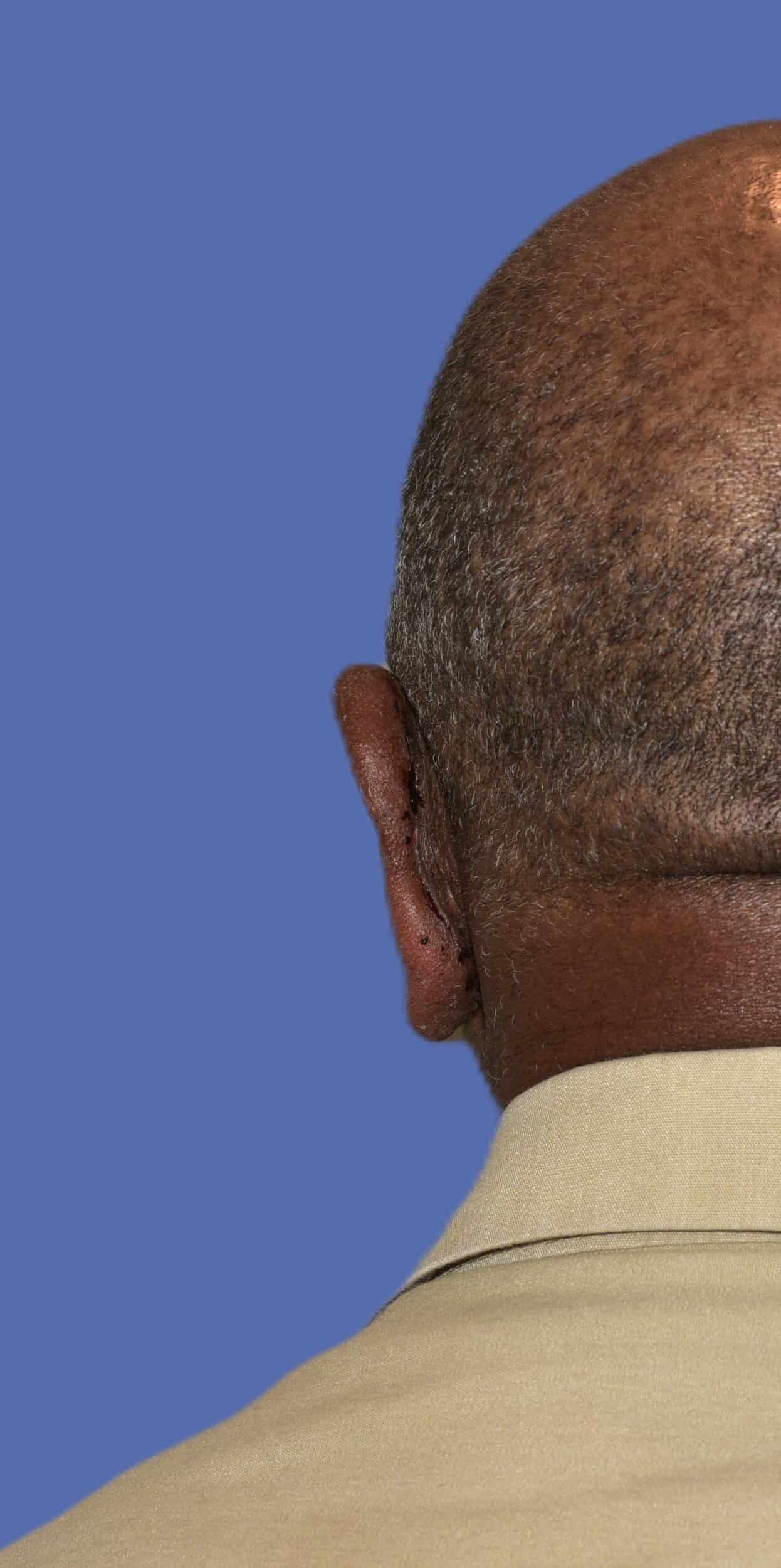 After Image: Otoplasty (Ear Pinning) - back