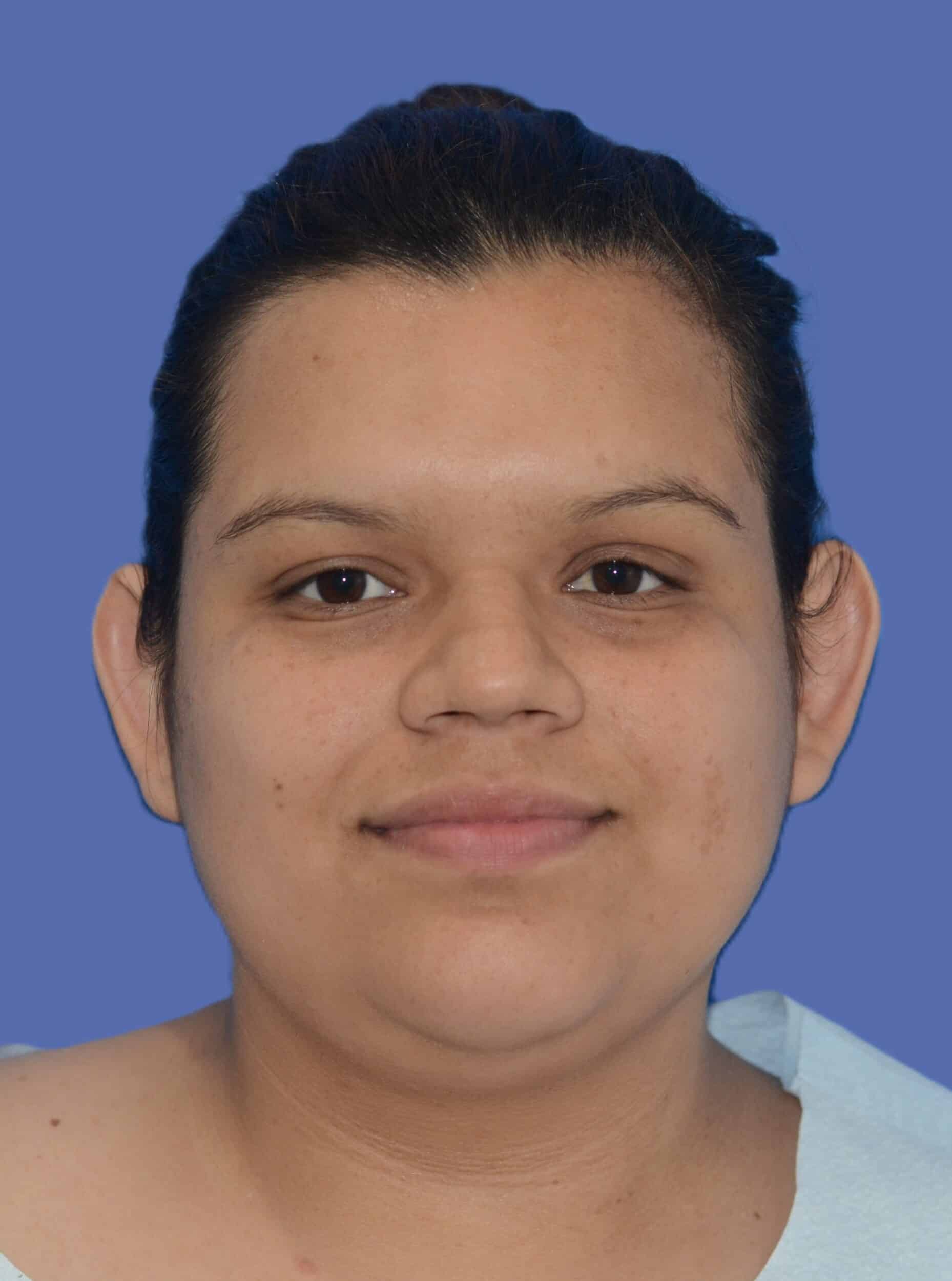 Before Image: Otoplasty (Ear Pinning) - front