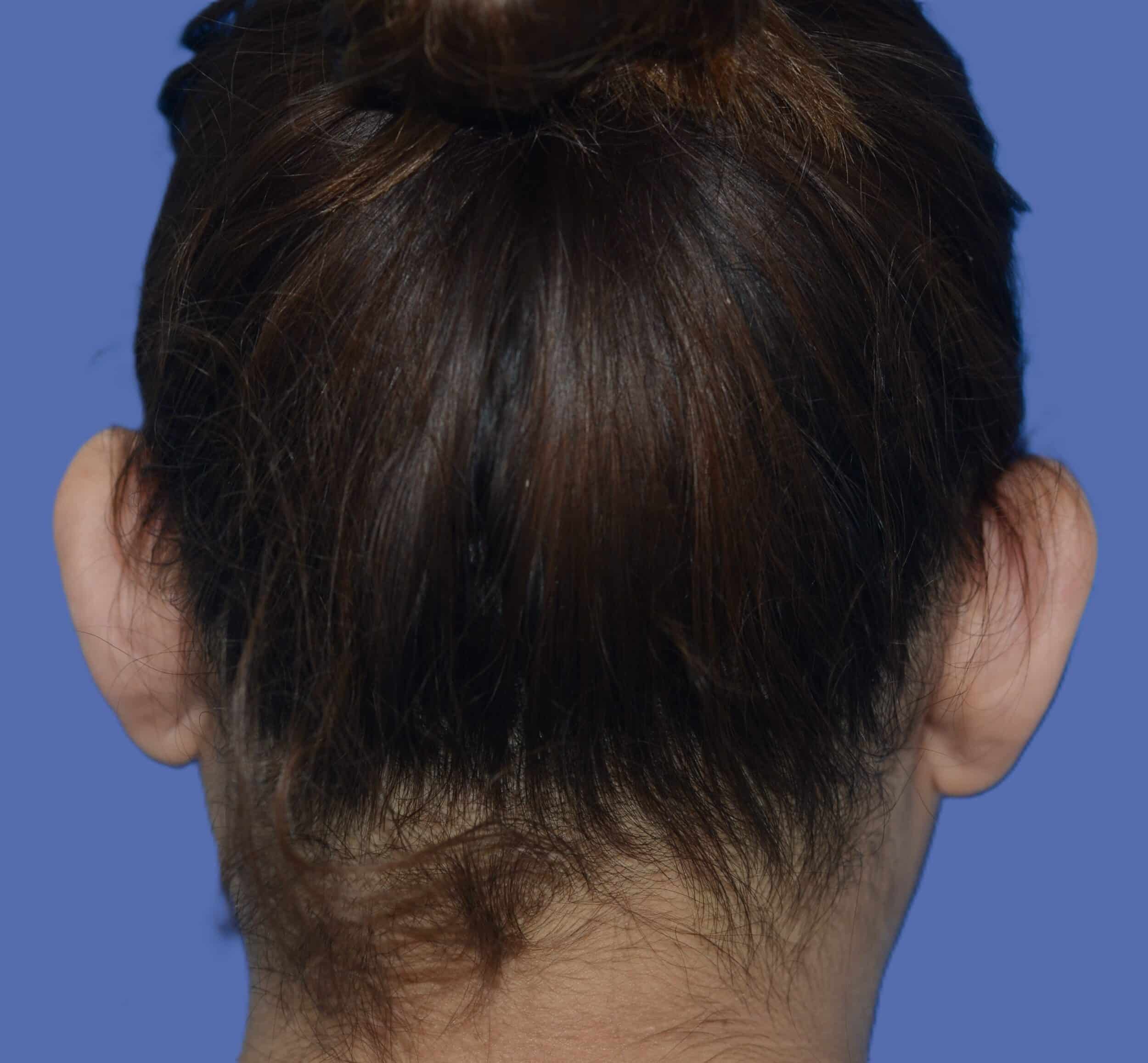 Before Image: Otoplasty (Ear Pinning) - back