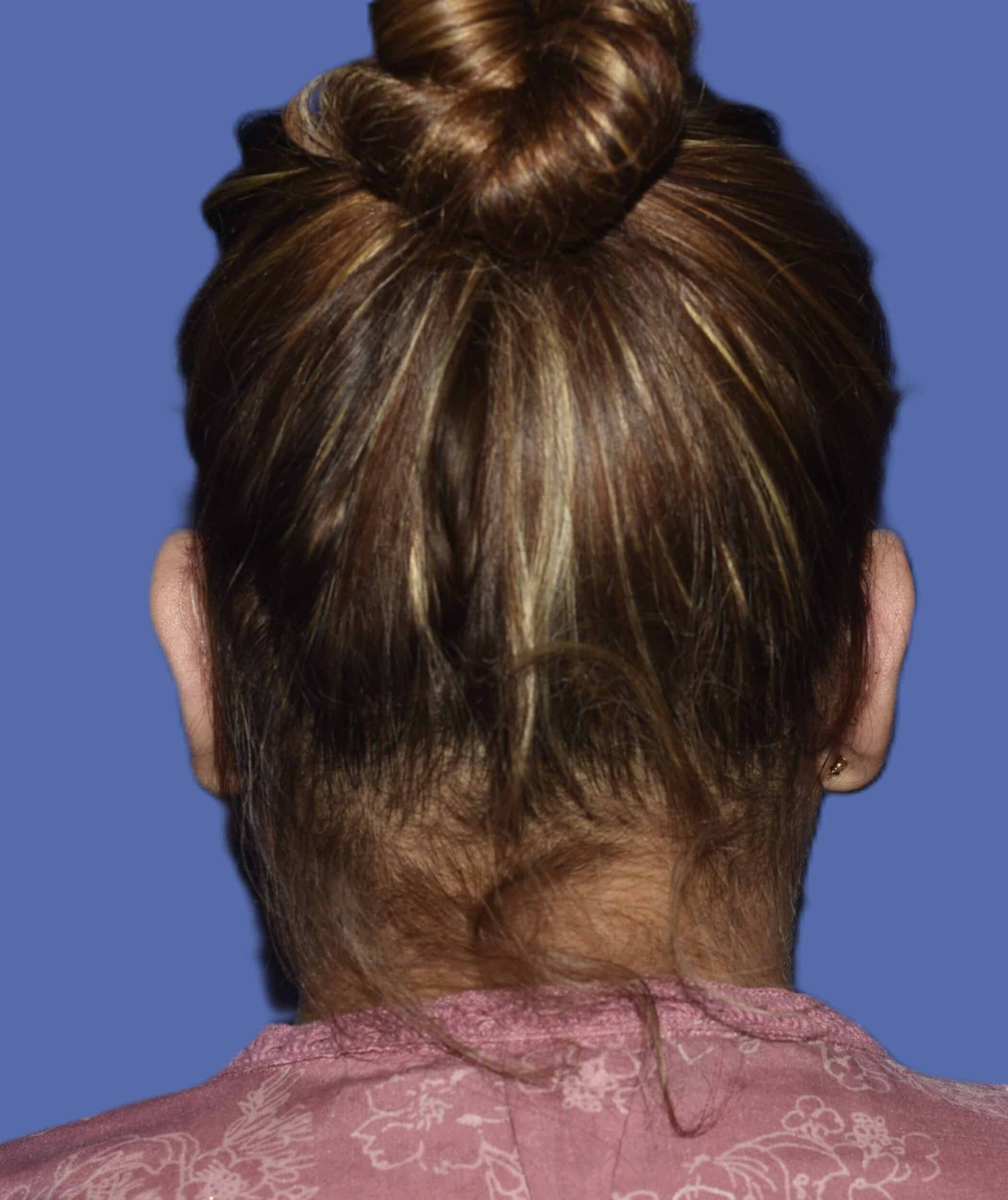 After Image: Otoplasty (Ear Pinning) - back