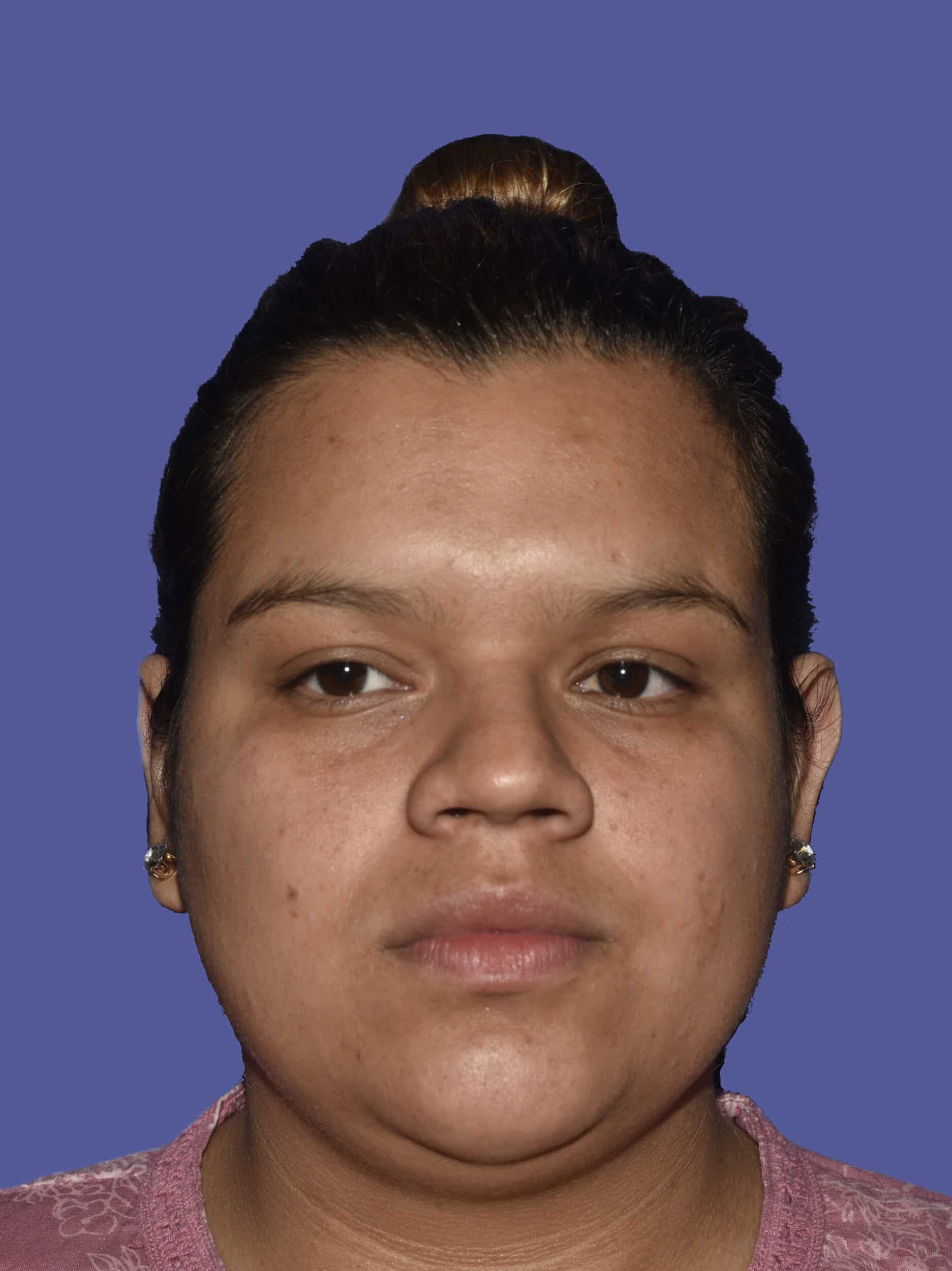 After Image: Otoplasty (Ear Pinning) - front