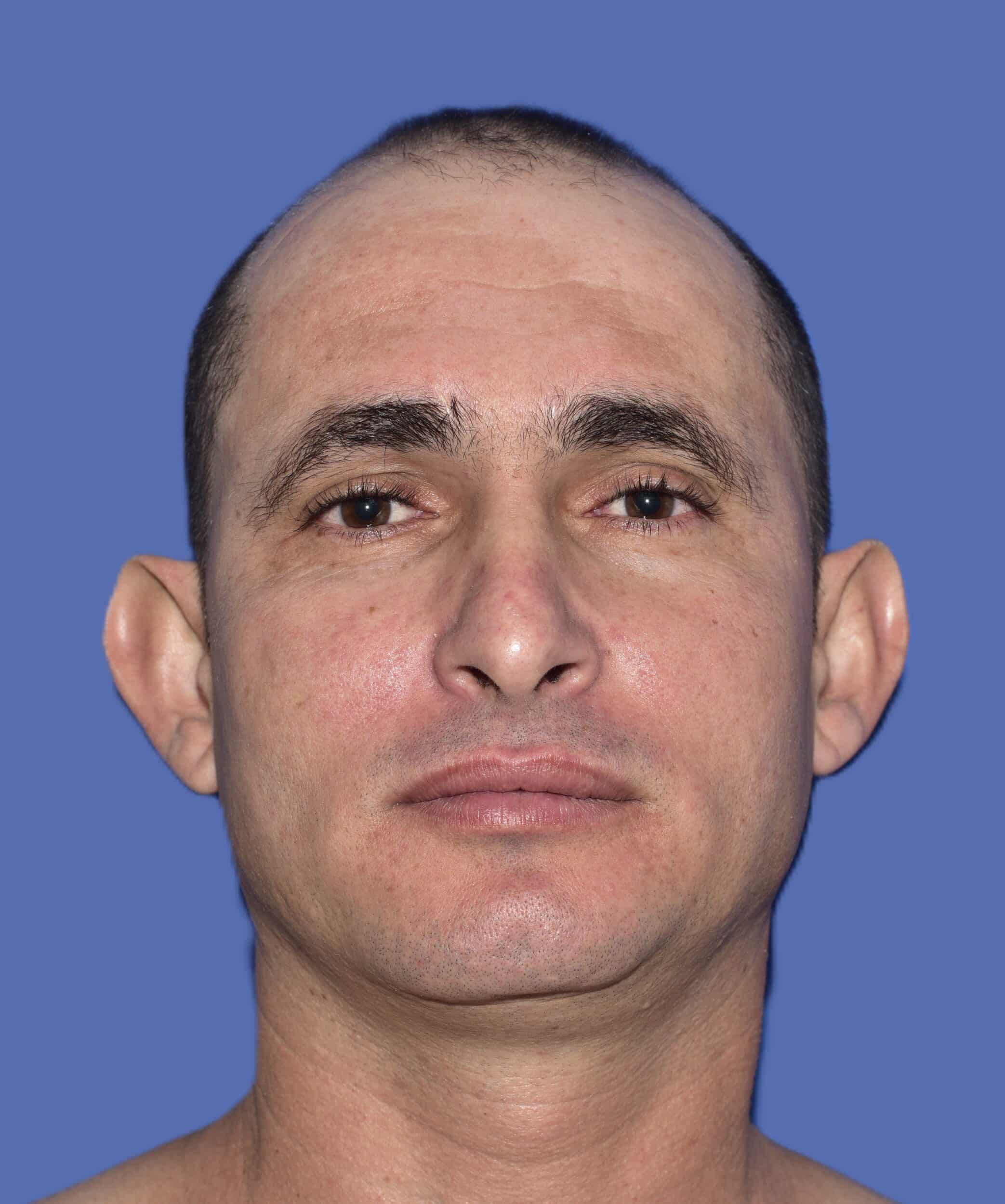 Before Image: Otoplasty (Ear Pinning) - front