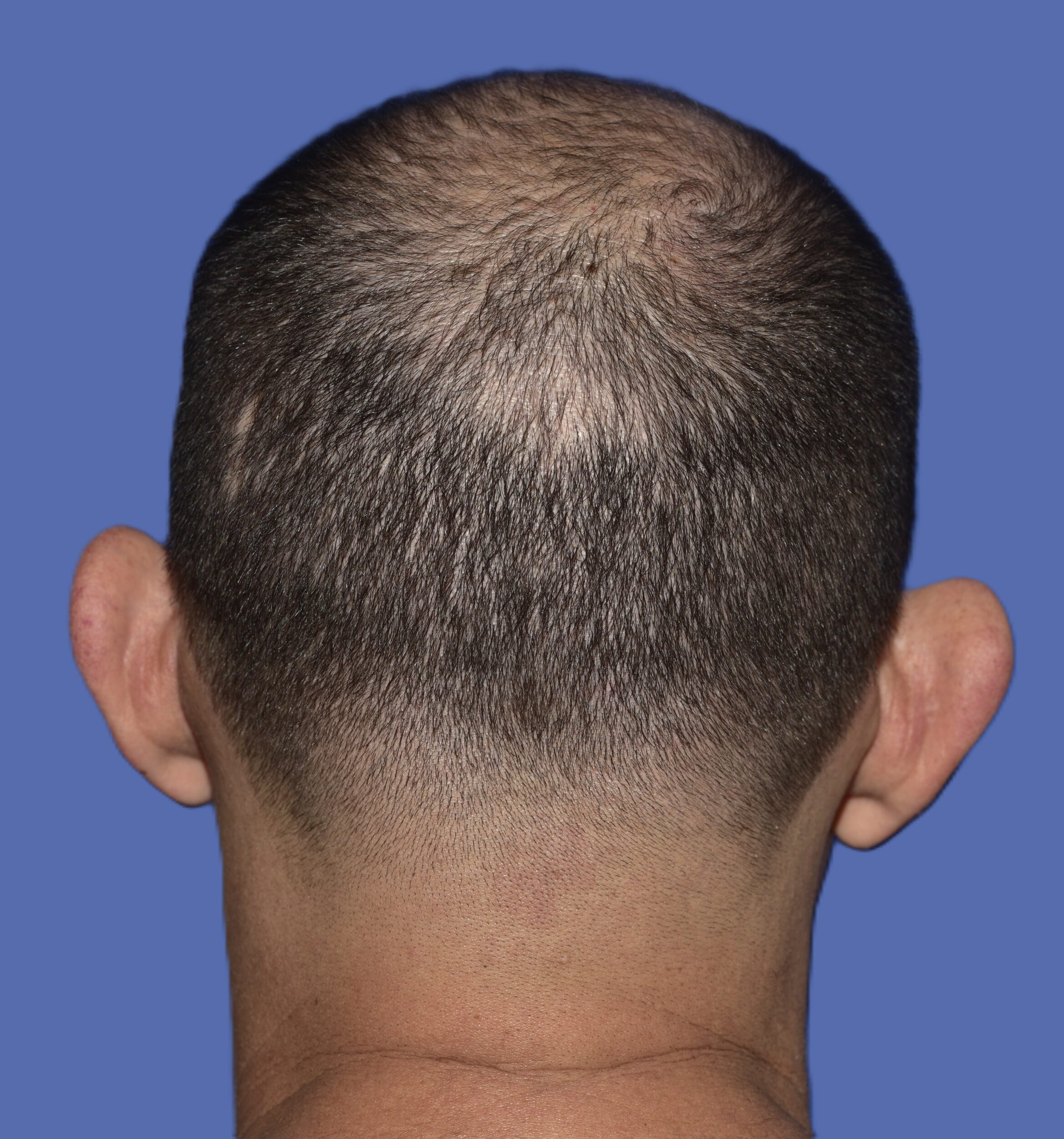 Before Image: Otoplasty (Ear Pinning) - back