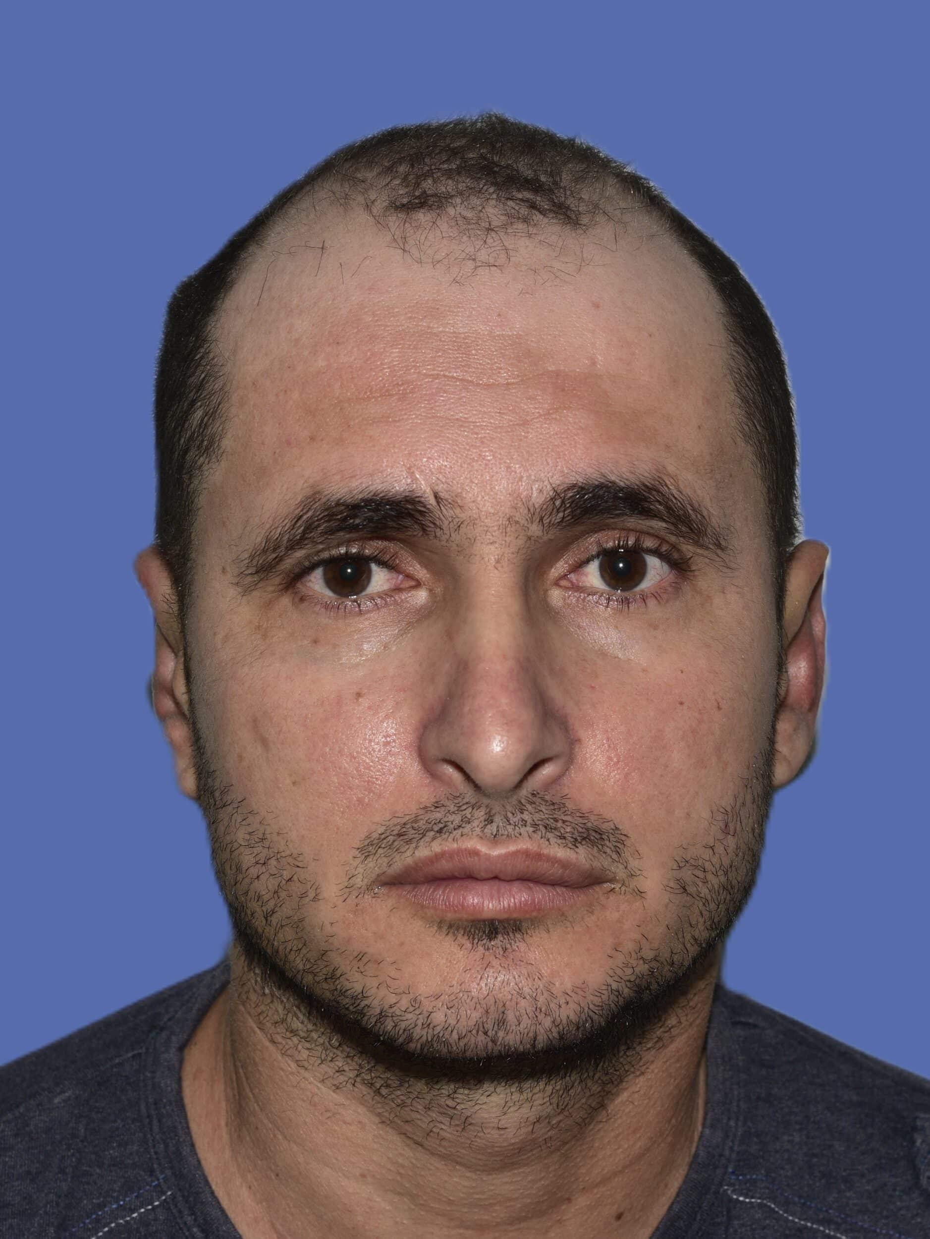 After Image: Otoplasty (Ear Pinning) - front