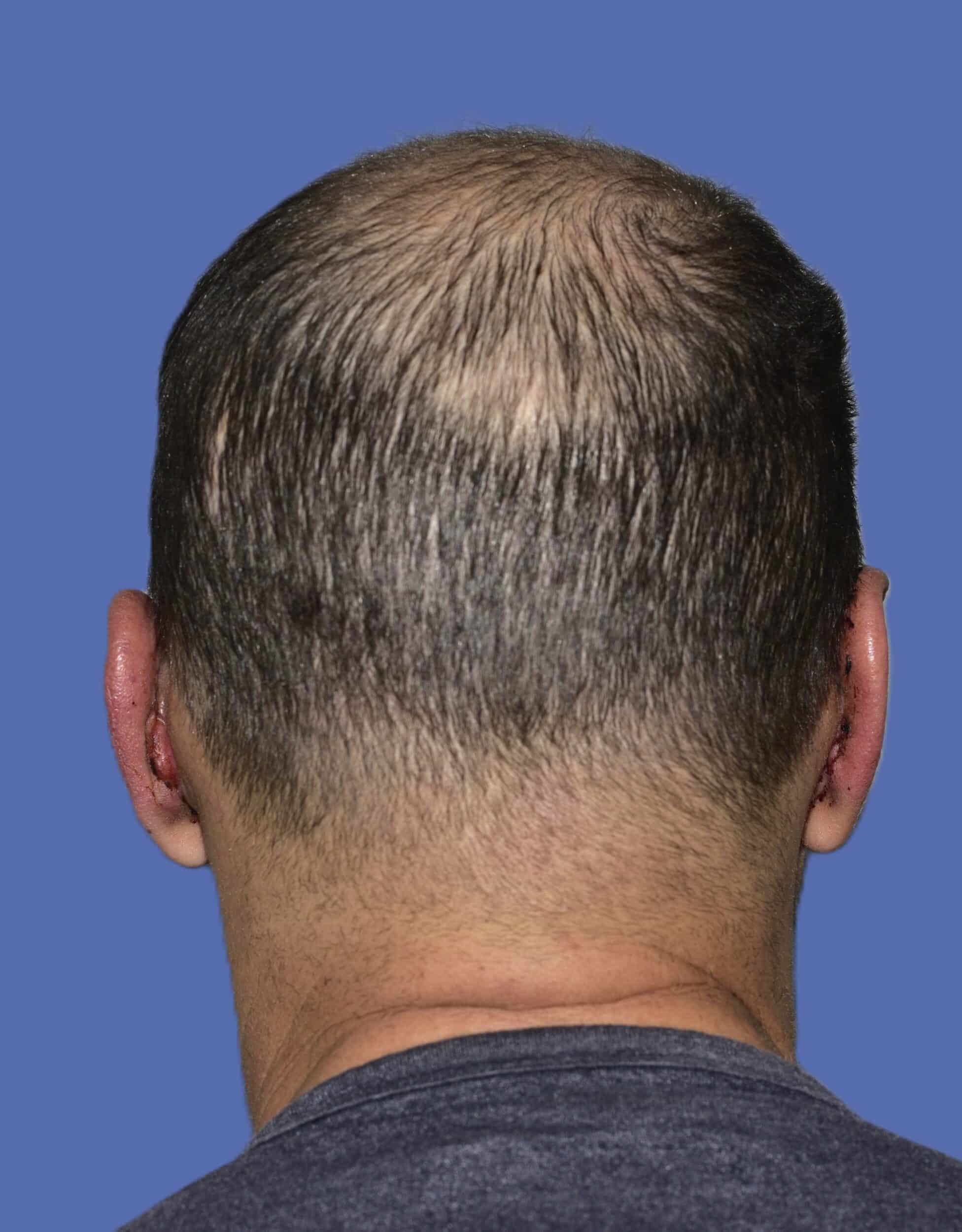 After Image: Otoplasty (Ear Pinning) - back