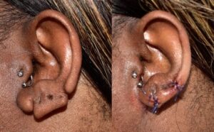 Split Lobe Repaired