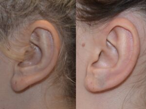 Elongated Lobe Repaired