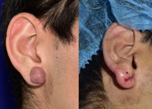 Keloid Removed