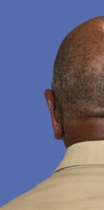 After Image: Otoplasty (Ear Pinning) - back