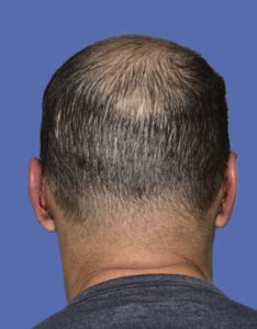 After Image: Otoplasty (Ear Pinning) - back