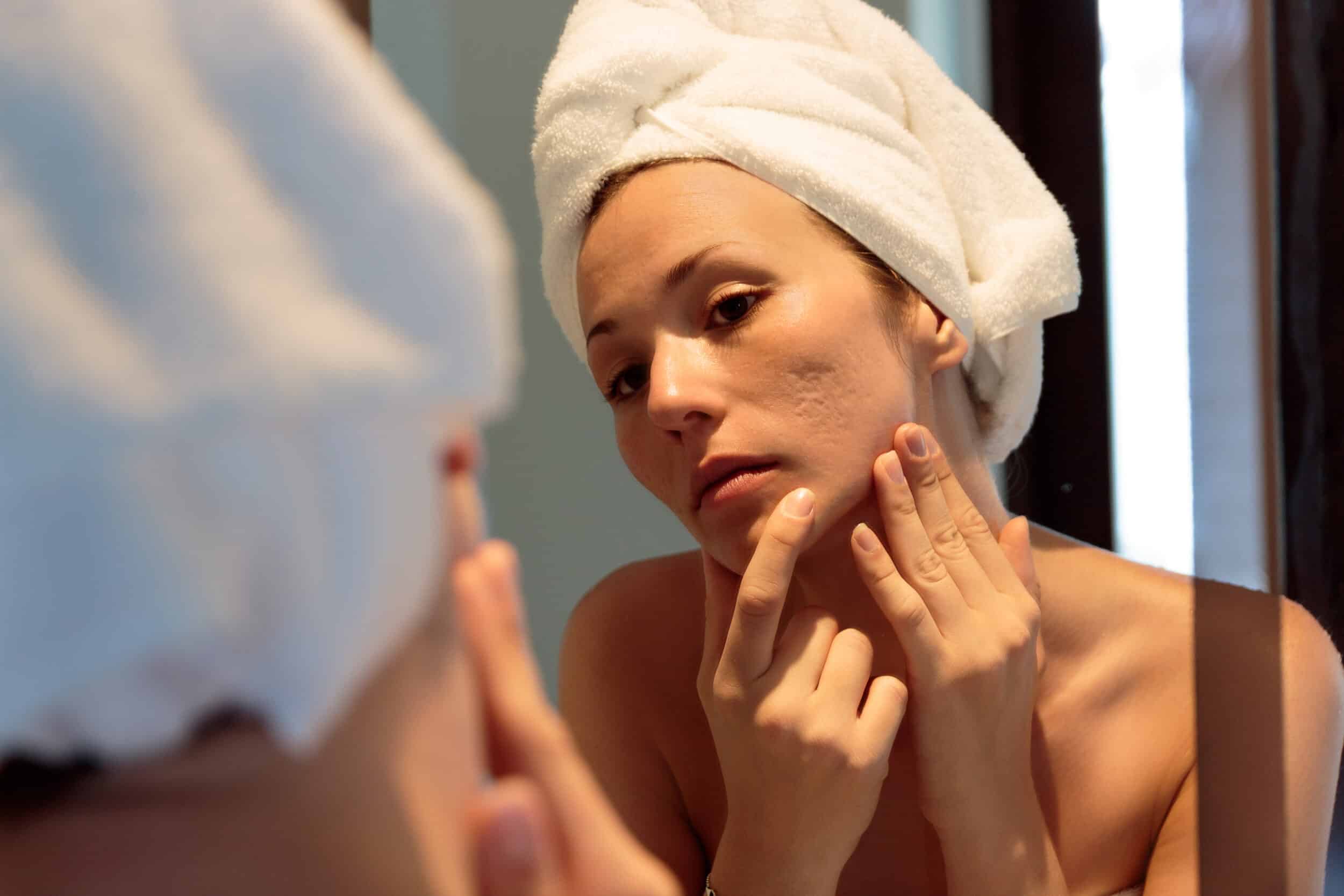 Woman examining acne scars before laser scar treatment