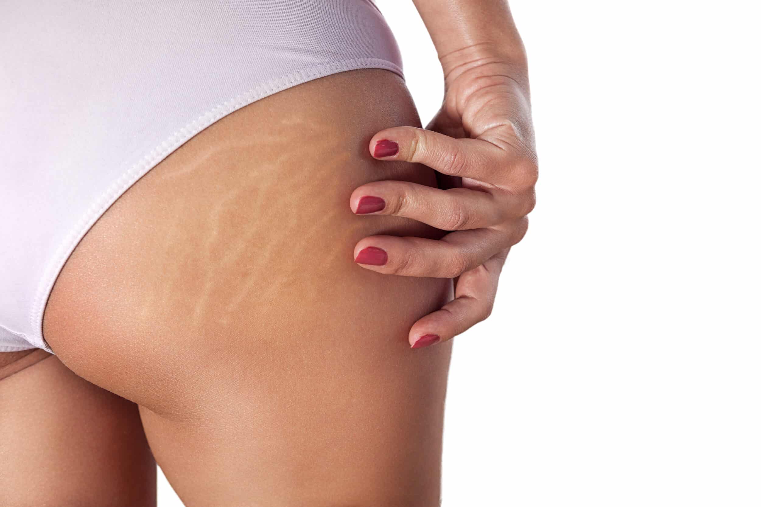 Stretch marks before laser treatment