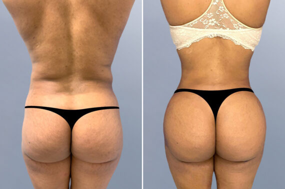 Body Procedures before and after photos in FL, Palm Beach Gardens, Patient 1000