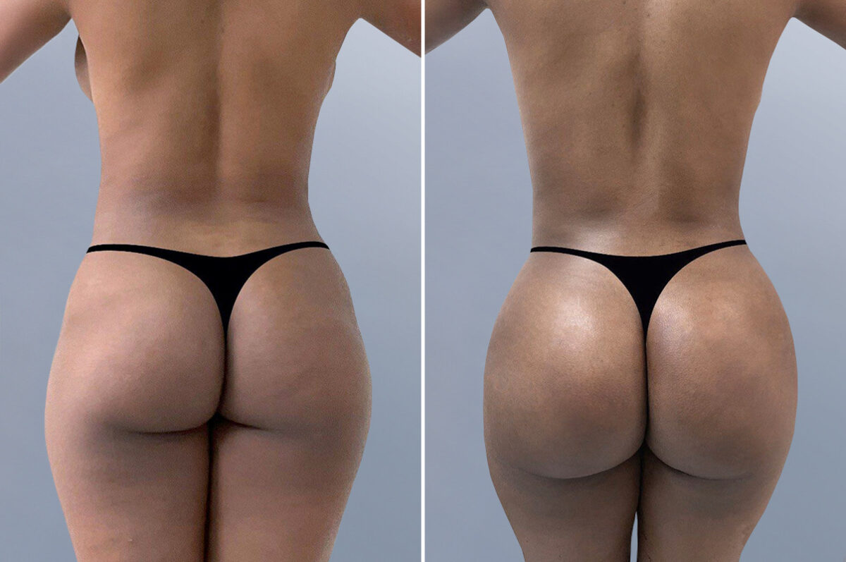 Body Procedures before and after photos in FL, Palm Beach Gardens, Patient 1003