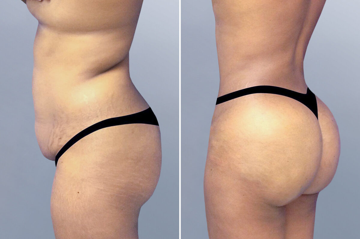 Body Procedures before and after photos in FL, Palm Beach Gardens, Patient 1006