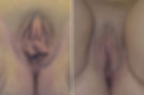 Labiaplasty before and after photos in FL, Palm Beach Gardens