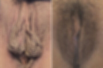 Body Procedures before and after photos in FL, Palm Beach Gardens, Patient 1034