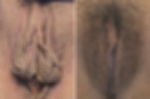 Body Procedures before and after photos in FL, Palm Beach Gardens, Patient 1034