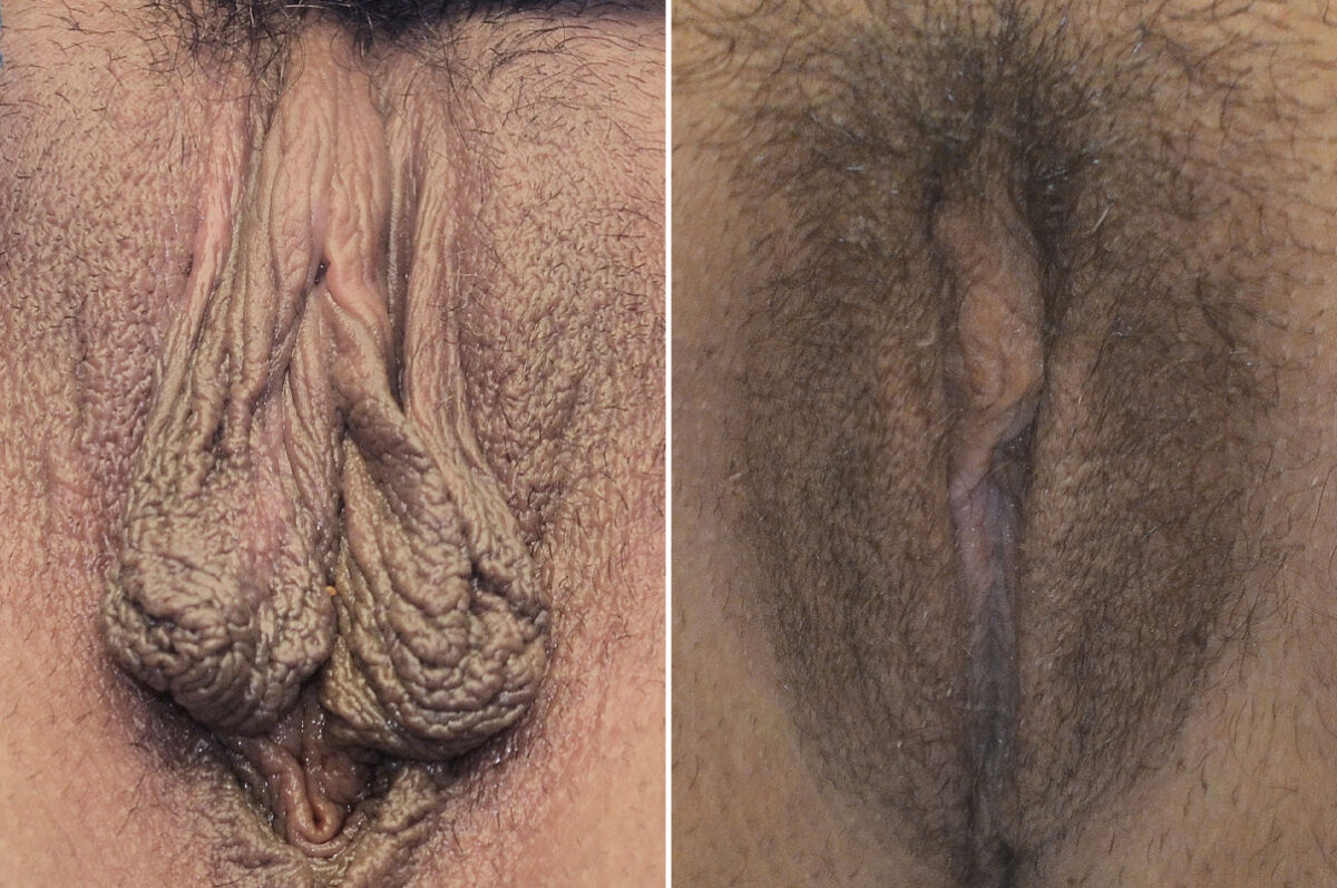 Body Procedures before and after photos in FL, Palm Beach Gardens, Patient 1034