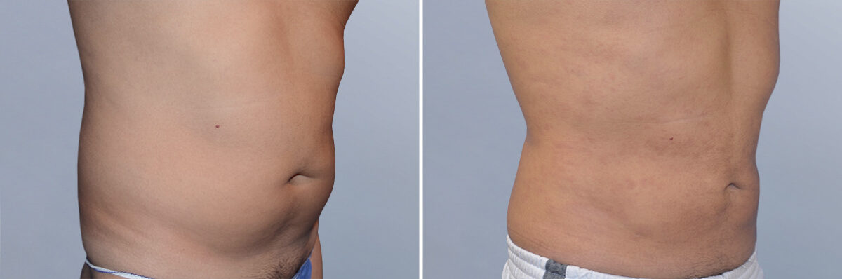 Body Procedures before and after photos in FL, Palm Beach Gardens, Patient 1037
