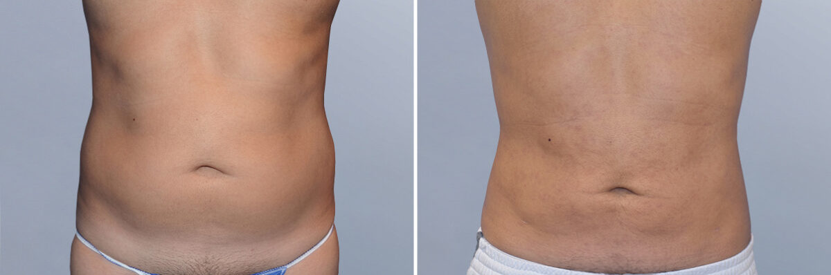 Body Procedures before and after photos in FL, Palm Beach Gardens, Patient 1037