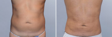 Body Procedures before and after photos in FL, Palm Beach Gardens, Patient 1037