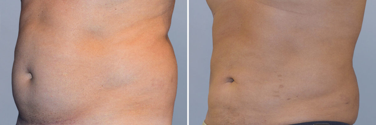 Body Procedures before and after photos in FL, Palm Beach Gardens, Patient 1042