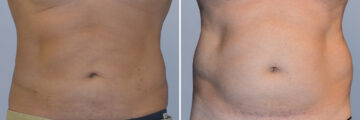 Body Procedures before and after photos in FL, Palm Beach Gardens, Patient 1042